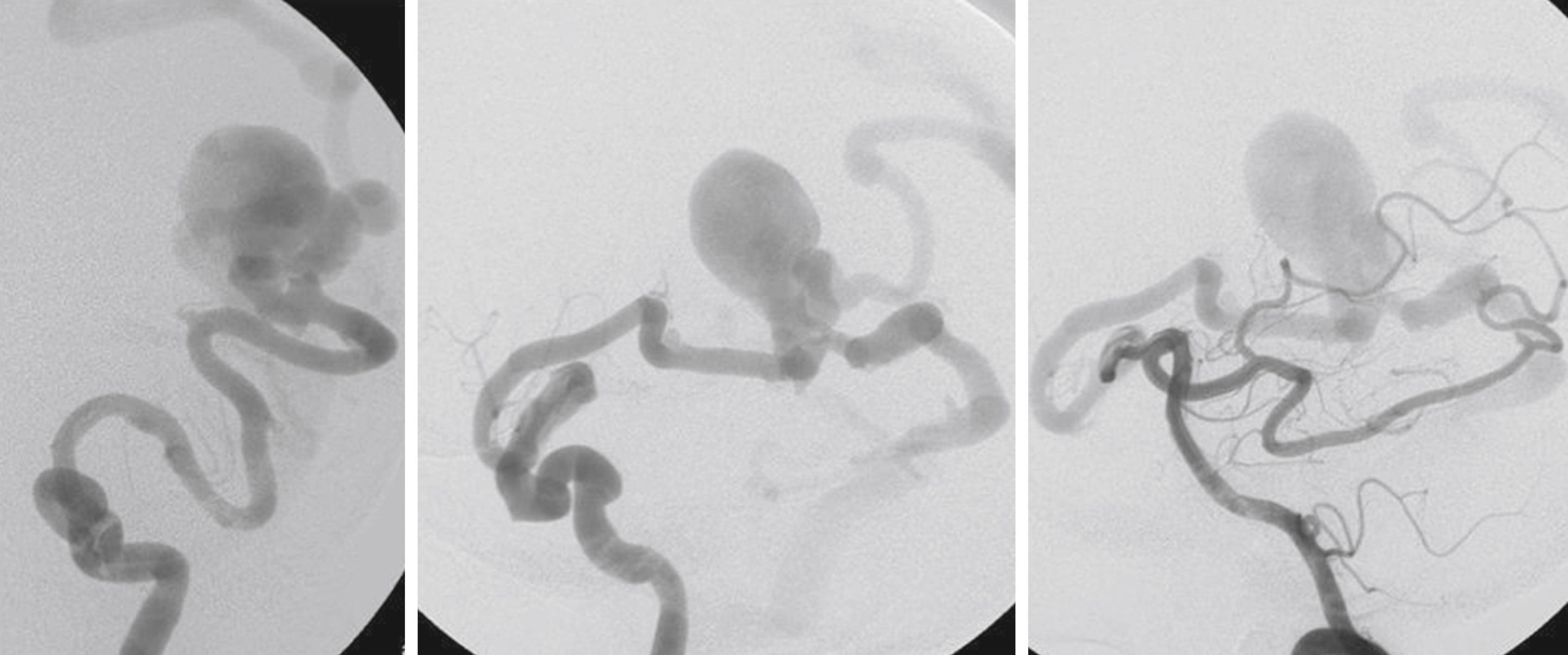 Fig. 69.1, Fistulous pial arteriovenous malformation with a high-flow shunt. They typically present in early childhood, can lead to developmental delay or cardiac insufficiency, and should be treated. Multiple shunts of this type are characteristic of HHT (hereditary hemorrhagic telangiectasia).