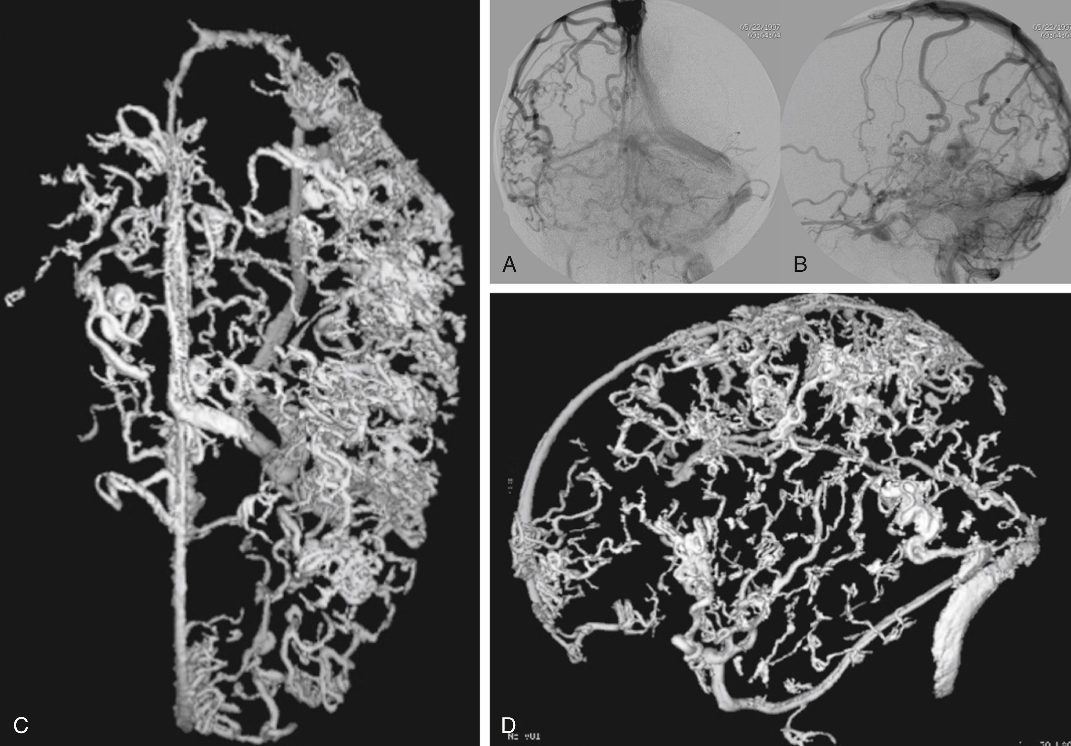 Fig. 69.2, Severe persistent venous congestion in a patient with a treated vein of Galen malformation. Shown are anteroposterior and lateral vertebral angiograms (A) and (B), and 3-dimensional (3D) surface-rendered reconstructions of the 3D rotational angiogram (C, D).