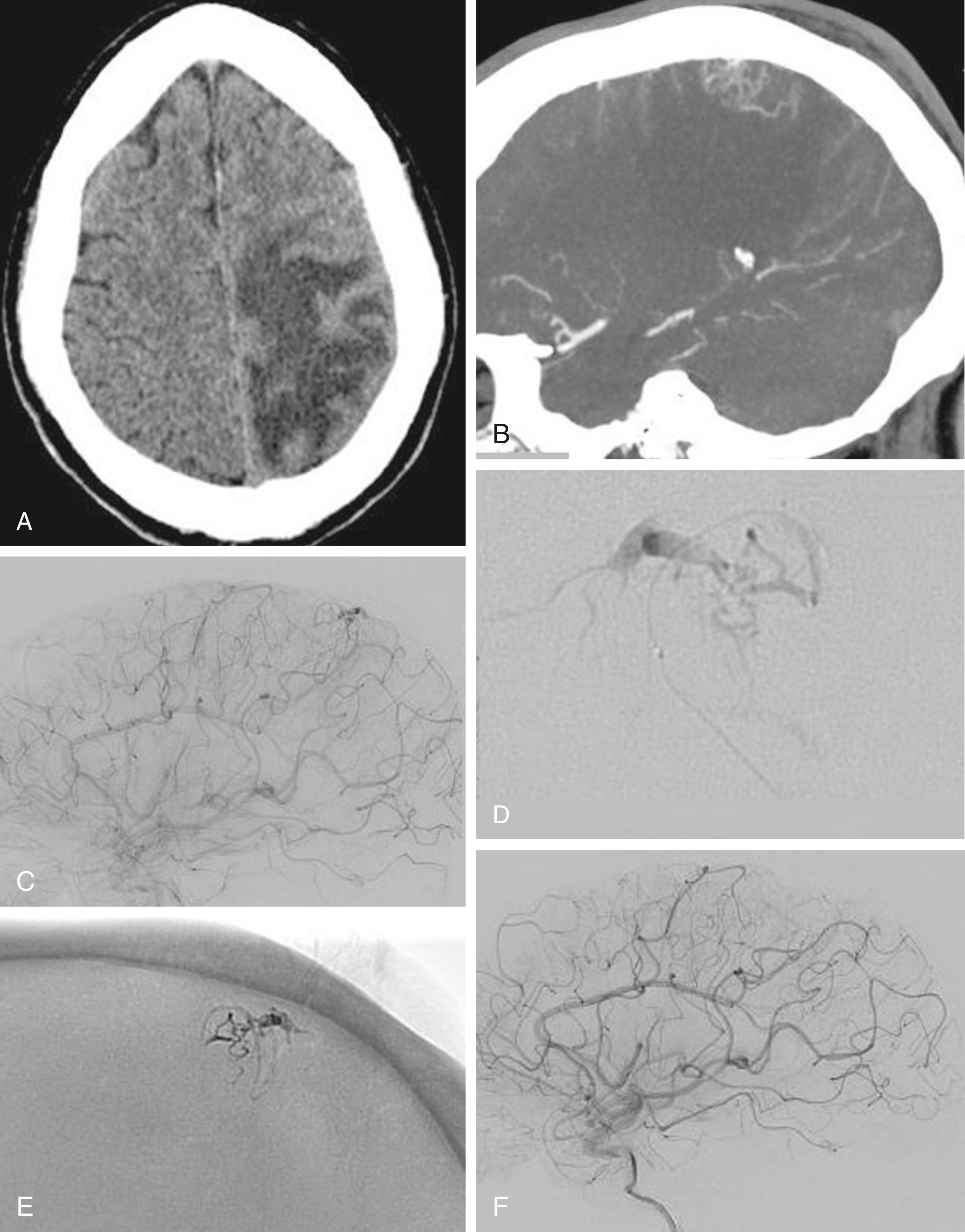 Fig. 69.3, Venous congestion and treatment. Despite being a non-ruptured arteriovenous malformation (AVM), the progressive venous stenosis, we feel, may predispose this patient toward a more malignant course. In this situation, we felt treatment of this non-ruptured AVM was warranted. (A) Axial noncontrast and (B) sagittal postcontrast maximal intensity projection computed tomography showing severe left frontoparietal edema secondary to a non-ruptured AVM. (C) Left internal carotid artery (ICA) injection, lateral view, showing the small left parietal AVM. (D) Magnified view of a microcatheter injection during treatment, showing a thrombosed draining vein. (E) Post-embolization radiograph showing the glue cast obliterating the AVM nidus. (F) Post-treatment left ICA lateral angiogram, showing complete obliteration of the AVM.