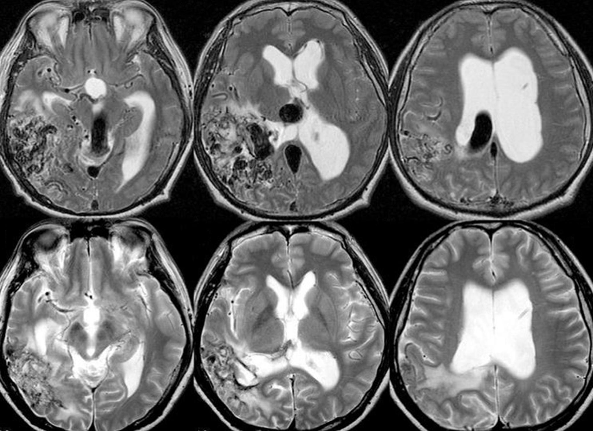 Fig. 69.4, In rare cases, mass effect of the nidus proper, or, as present in this case, of the dilated draining vein on critical structures (aqueduct, 3rd ventricle) may lead to hydrocephalus (upper row) . Following partial embolization and radiosurgery, the size of the draining vein was reduced, leading to resolution of the mass effect and concomitant resolution of the hydrocephalus (lower row) .