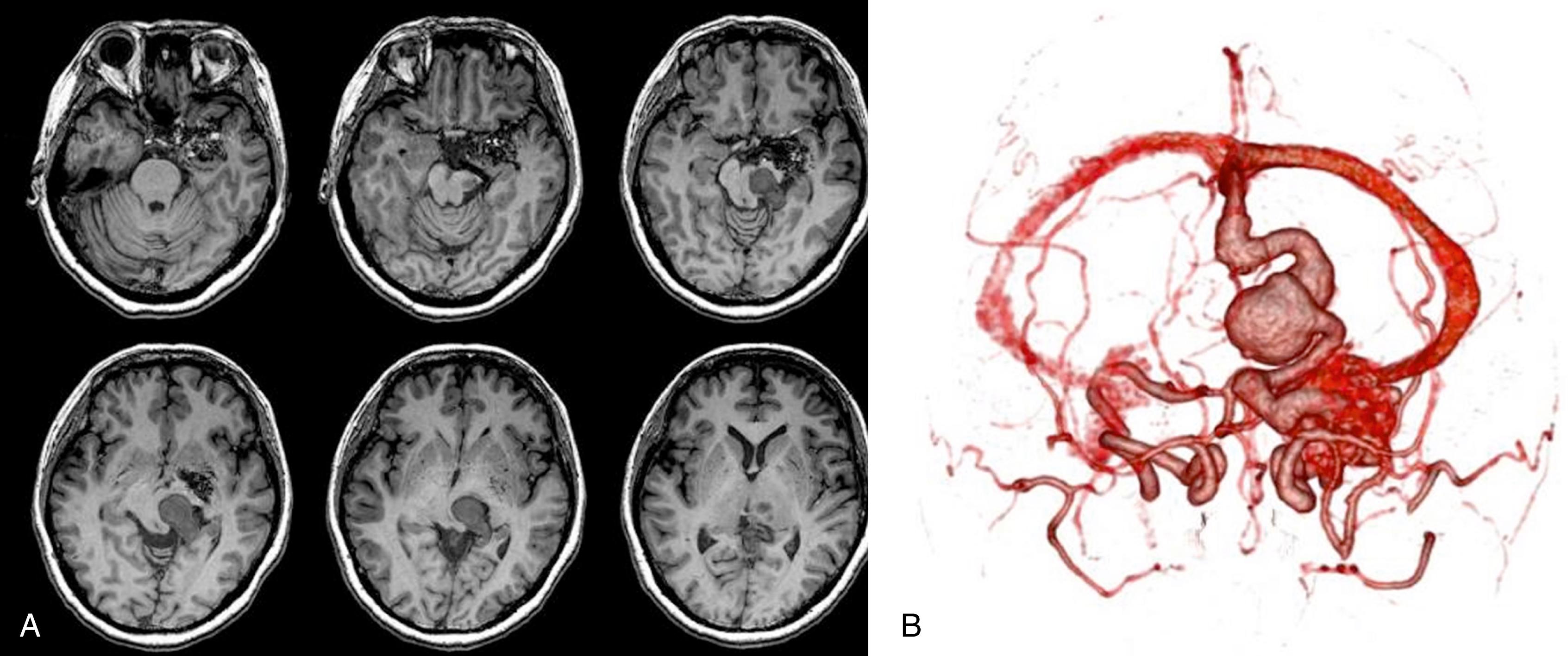 Fig. 69.5, Unruptured left hippocampal arteriovenous malformation (AVM). Note the enlarged (lateral perimesencephalic) draining vein, which is causing significant mass effect with compression of the left side of the pons and left thalamus. This patient presented with progressive right-sided hemiparesis, from compression of eloquent structures by this unruptured AVM. Shown are post-contrast T1 weighted magnetic resonance angiography images (A) and surface-rendered 3-dimensional image from a rotational angiogram (B).