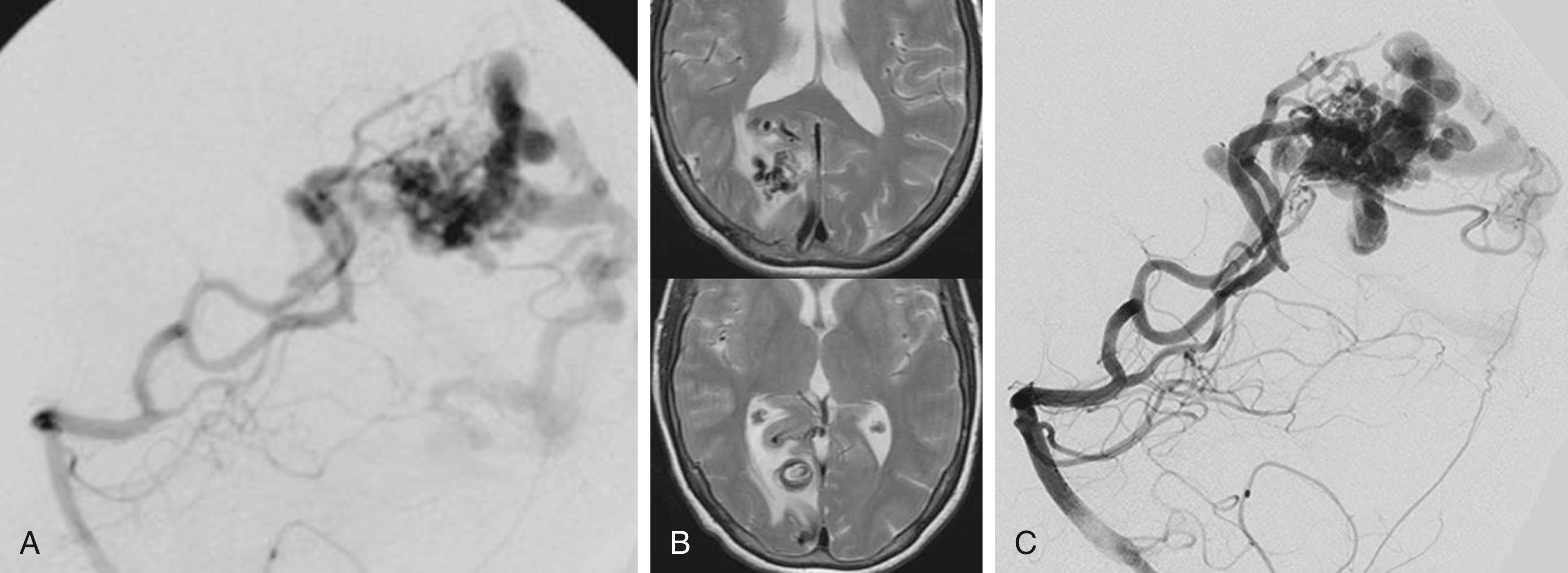 Fig. 69.6, Growing intranidal aneurysm—vertebral artery injection, lateral view in 2010 (A) and subsequently in 2018 (B), demonstrating a brain arteriovenous malformation that has developed a new enlarging inferiorly pointing aneurysm (blue arrow) . This aneurysm is also demonstrated on the T2 axial magnetic resonance imaging sequences, the latter of which (C) shows the aneurysm has enlarged with an increase in the surrounding edema. We believe that these intranidal aneurysms represent a so-called angiographic weak point, predisposing the patient to hemorrhage.