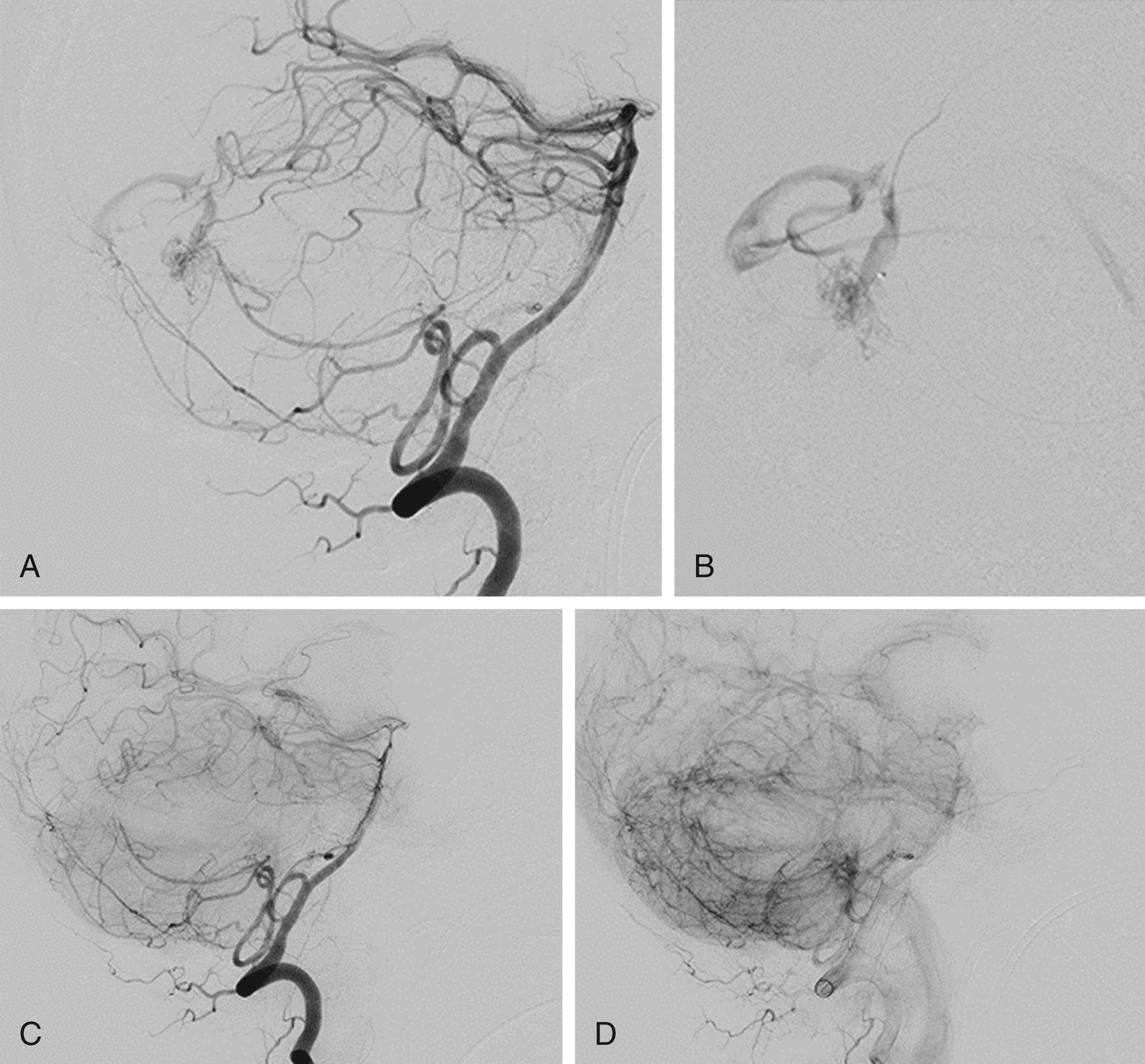 Fig. 69.7, Venous stenosis and glue embolization—Lateral view of a vertebral injection angiogram (A), showing a cerebellar arteriovenous malformation (AVM) fed mainly by by distal branches of the posterior inferior cerebellar artery. There is significant venous narrowing that is seen on the global vertebral artery injection but also on the microcatheter injection (B). This venous stenosis led to previous rupture, secondary to significant retrograde pressure on the AVM. Following treatment (C and D), there was complete obliteration of the AVM, with no evidence of any residual shunting. Venous stenosis predisposes AVMs to rupture and can also be considered a focal angiographic weak point.