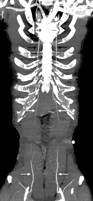FIGURE 16-1, Thick slab coronal MIP image from a CTA shows the positions of the internal mammary (black arrows), superior epigastric (white arrows), and inferior epigastric (block arrows) arteries. These must be identified and avoided during procedures involving an anterior approach.