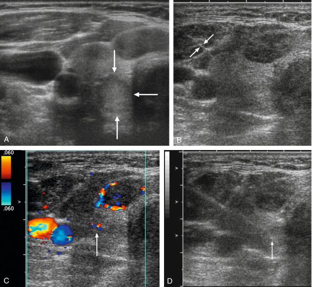 FIGURE 16-2, Thyroid fine needle aspiration biopsy. (A) Grey scale US image shows an isoechoic posterior right thyroid nodule (arrows). (B) The proximal needle (arrows) is visualised within hypoechoic muscle but the tip is difficult to identify as it enters more echogenic tissue. (C) Colour Doppler image shows colour flow at the tip of the needle (arrow) as it is gently jiggled back and forth, as well as demonstrating the internal jugular vein and carotid artery. (D) After the needle tip and vessels are identified, colour Doppler is turned off and the needle tip (arrow) is seen in the nodule while avoiding the vessels.