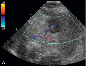FIGURE 16-4, Hypoechoic liver lesion biopsy in a patient with metastatic breast cancer. (A) Colour Doppler image shows a tumour vessel along the posterior aspect of the liver mass. (B) Colour Doppler image showing the biopsy trajectory (arrow) in the anterior portion of the mass in order to avoid this vessel.