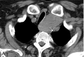 FIGURE 16-5, A 65-year-old man with a history of melanoma and neck mass. (A) Non-contrast CT through the neck reveals a soft tissue attenuation mass in the superior mediastinum displacing the trachea. A CT-guided biopsy was requested, however, the lesion was first studied with US. (B) Grey scale US reveals a hypoechoic mass, however colour Doppler (C) shows the classic ‘yin-yang’ pattern of a pseudoaneurysm and biopsy was deferred.