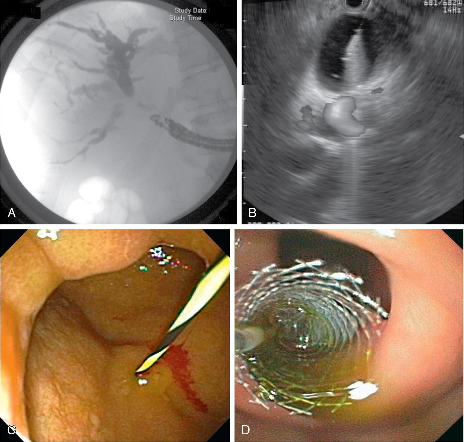 FIGURE 30.1, Endoscopic ultrasound (EUS)–guided biliary drainage.