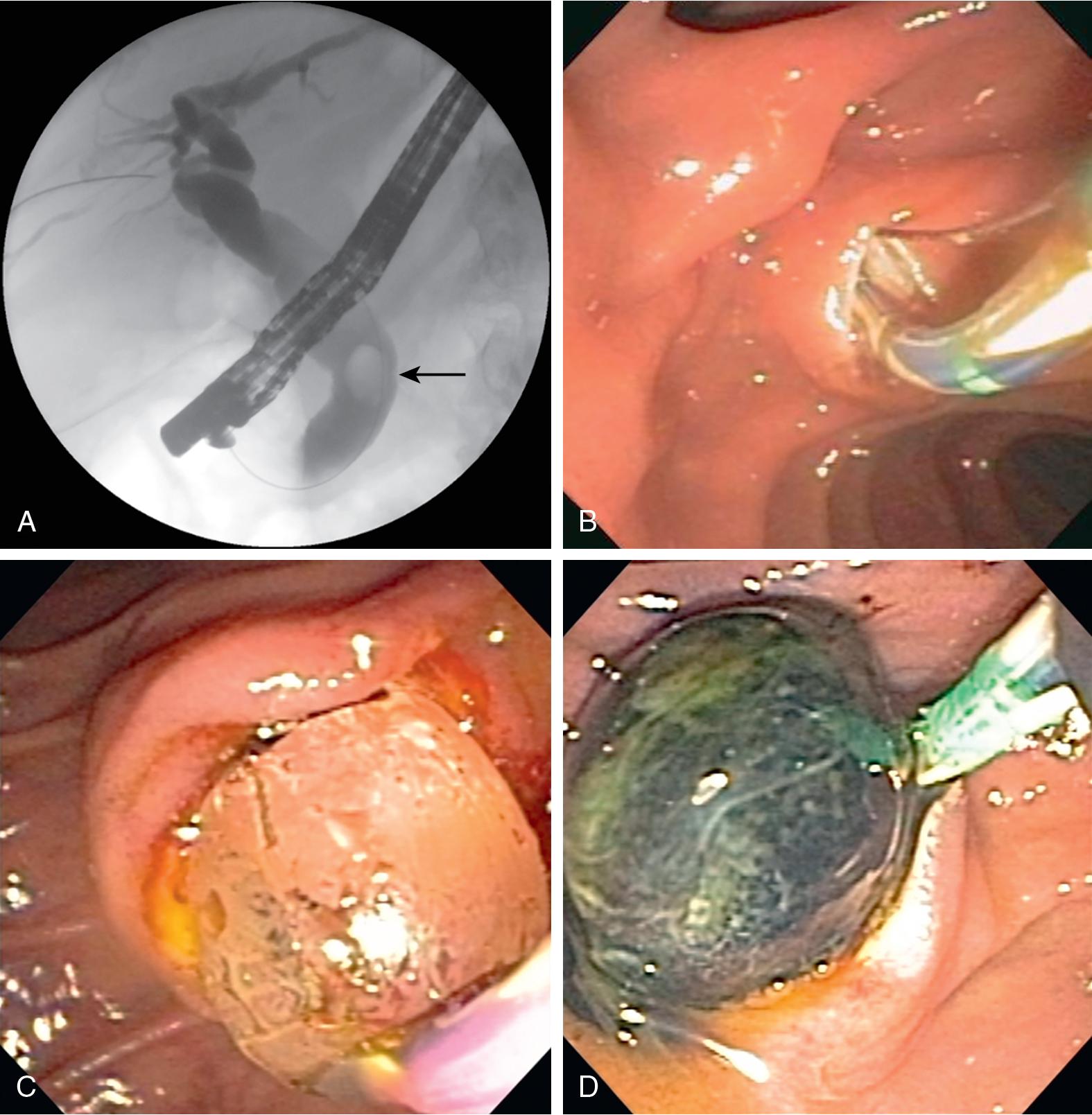 FIGURE 30.2, Endoscopic management of choledocholithiasis.