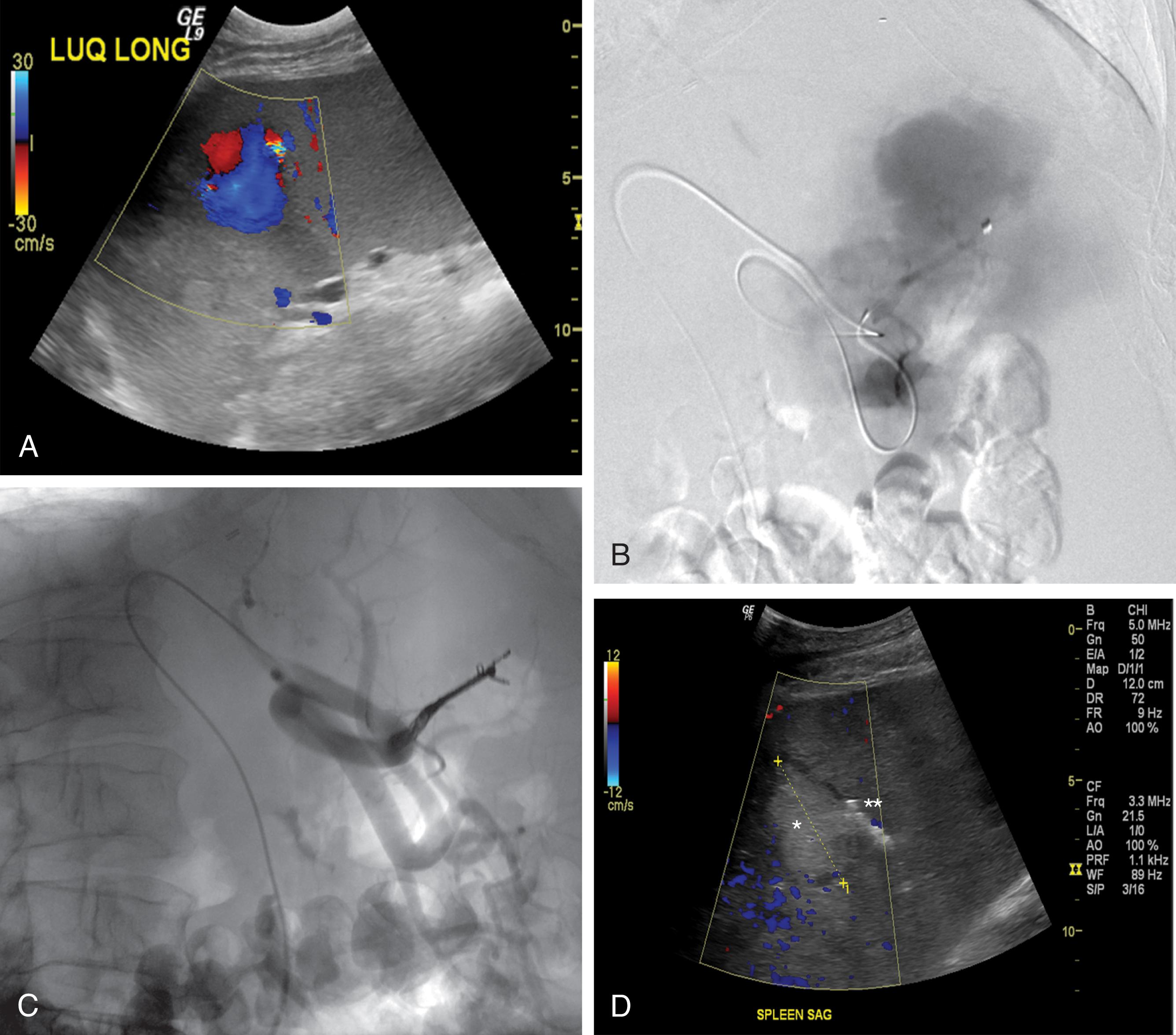 FIGURE 1, Sagittal color Doppler ultrasound (A) readily demonstrates a 4.5-cm upper pole splenic pseudoaneurysm confirmed by superselective splenic angiogram (B) . The pseudoaneurysm extends close to the capsule at the confirmed site of splenic injury seen on prior contrast-enhanced CT. Intraparenchymal pseudoaneurysm was treated with superselective embolization with detachable microcoils and liquid embolic (onyx) (C) . Postembolization Doppler ultrasound demonstrates no flow within the thrombosed pseudoaneurysm (single asterisk) as well as echogenic material (double asterisks) in the parent splenic artery branch (D) .