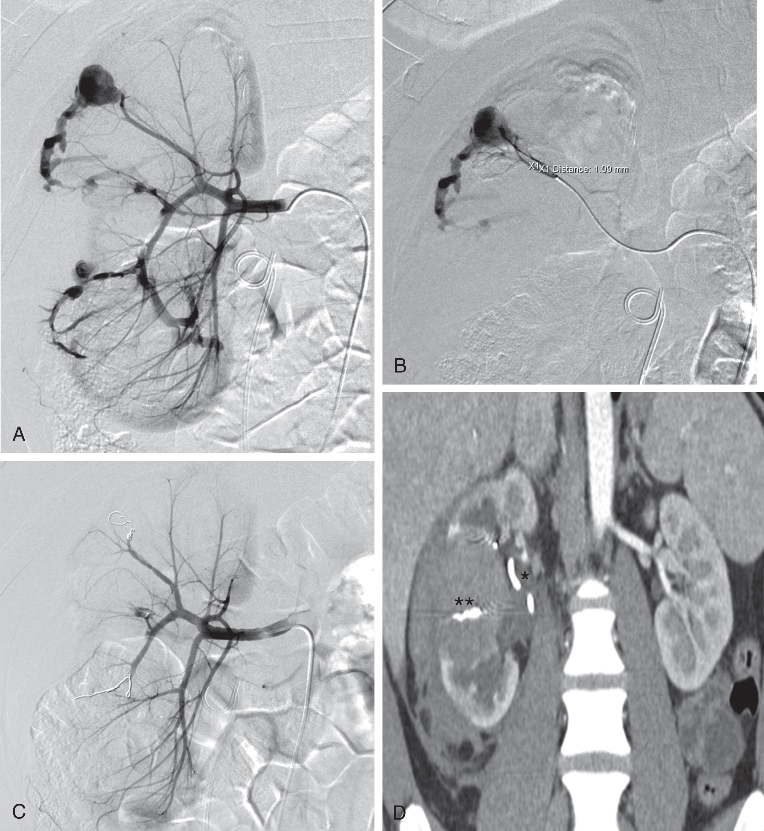 FIGURE 2, (A) Selective right renal angiography demonstrates multiple arteriovenous fistulas and intraparenchymal pseudoaneurysms. (B) Superselective interpolar arteriography demonstrates a well-defined pseudoaneurysm and communicated arteriovenous fistula. (C) Right renal angiogram post-superselective embolization with detachable microcoils demonstrates resolution of previously noted pseudoaneurysms and arteriovenous fistulas. (D) Follow-up contrast CT demonstrates maintained perfusion of the uninvolved renal parenchyma as well as an interpolar intraparenchymal hematoma. Ureteral stent (single asterisk) and microcoils (double asterisks) are noted.