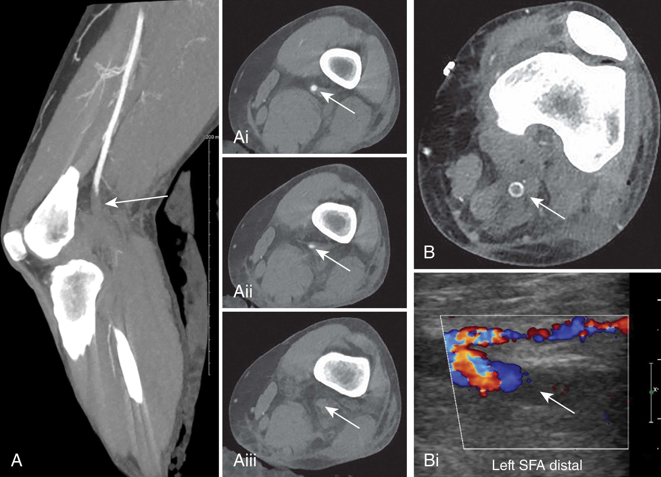 FIGURE 1, Thrombosed popliteal bypass graft placement during after hospital discharge. 35-year-old woman involved in motor vehicle crash with dashboard injury to right knee and pulseless right foot. (A–Aiii) CT scan of the lower extremity with axial and reformatted sagittal images shows dissection in the proximal popliteal artery (arrows) . She underwent open polytetrafluoroethylene (PTFE) graft placement, and flow was successfully restored to the right lower extremity. Three months later, she returned to emergency department with right lower extremity pain and diminished foot pulses after discontinuing her anticoagulation medication. (B, Bi) Color Doppler ultrasound and CT angiogram of the knee were obtained and popliteal graft was occluded. (C, Ci ) Antegrade femoral artery angiogram showed acute occlusion at the graft with poor below the knee runoff (arrows) . An external fixator device was placed by orthopedics because of knee instability. (D) Completion angiogram following 36 hours of catheter-directed thrombolysis with tissue plasminogen activator showed graft patency and restored below the knee runoff. She was restarted on oral anticoagulation and discharged home. SFA, superficial femoral artery.