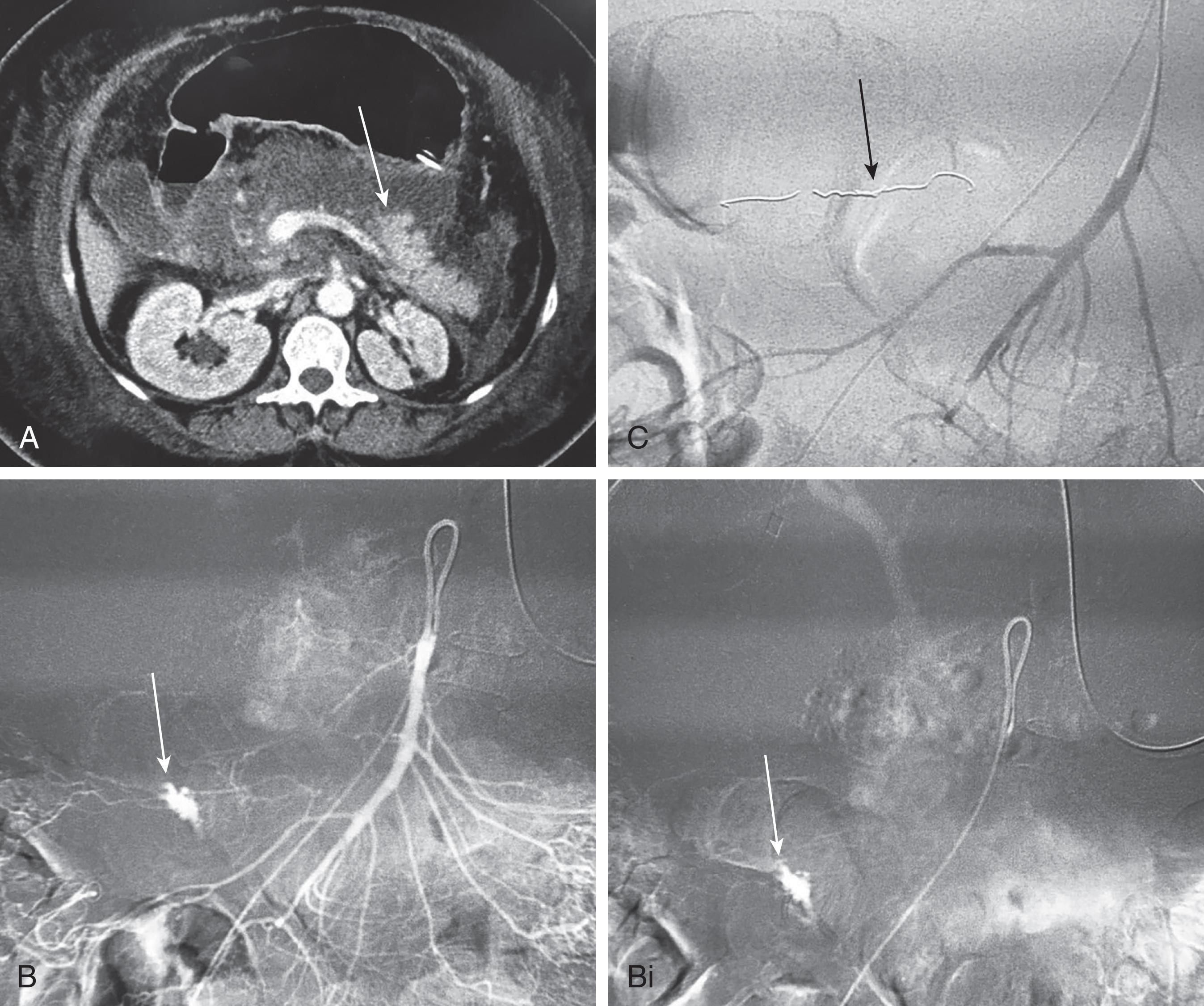 FIGURE 2, Delayed mesenteric hemorrhage following traumatic pancreatitis. 65-year-old woman was pinned in the front seat in motor vehicle crash and had abdominal pain and elevated lipase. (A) CT scan of the abdomen depicted fractured body of pancreas with retroperitoneal fluid. Initial treatment with endoscopic retrograde cholangiopancreatography cystogastrostomy. (B) Two weeks after trauma, she developed abdominal pain and decreased hemoglobin, and mesenteric angiography showed active bleeding in the right lower quadrant (RLQ) at the location of pancreatitis. (Bi) Delayed phase showing contained contrast in RLQ. (C) Microcatheter cannulation of a distal ilium branch and coil embolization of bleeding branch.