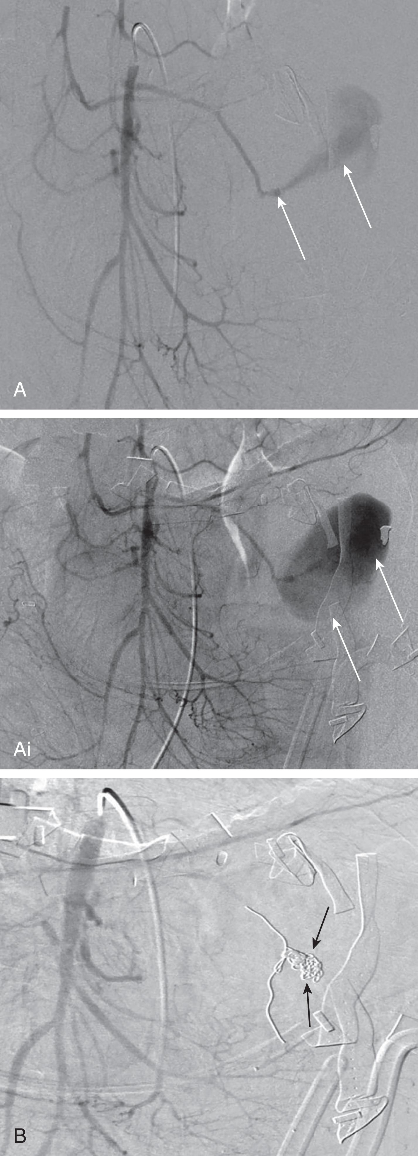 FIGURE 3, Delayed mesenteric pseudoaneurysm formation following exploratory surgery for a gunshot wound. One week after operative bowel repair after mesenteric injury for gunshot wound to the abdomen. Decrease hemoglobin and tachycardia and CT scan showing soft tissue mass in the left upper quadrant. (A, Ai) Superior mesenteric arteriogram shows first jejunal branch large pseudoaneurysm (PSA) with expansile delayed filling from end of arterial branch (arrows) . (B) PSA extends into the bed of left abdomen surgical drains (arrows). (C) Subselective microcatheterization of the distal jejunal branch and coil embolization pack and controlled active bleeding (arrows) .