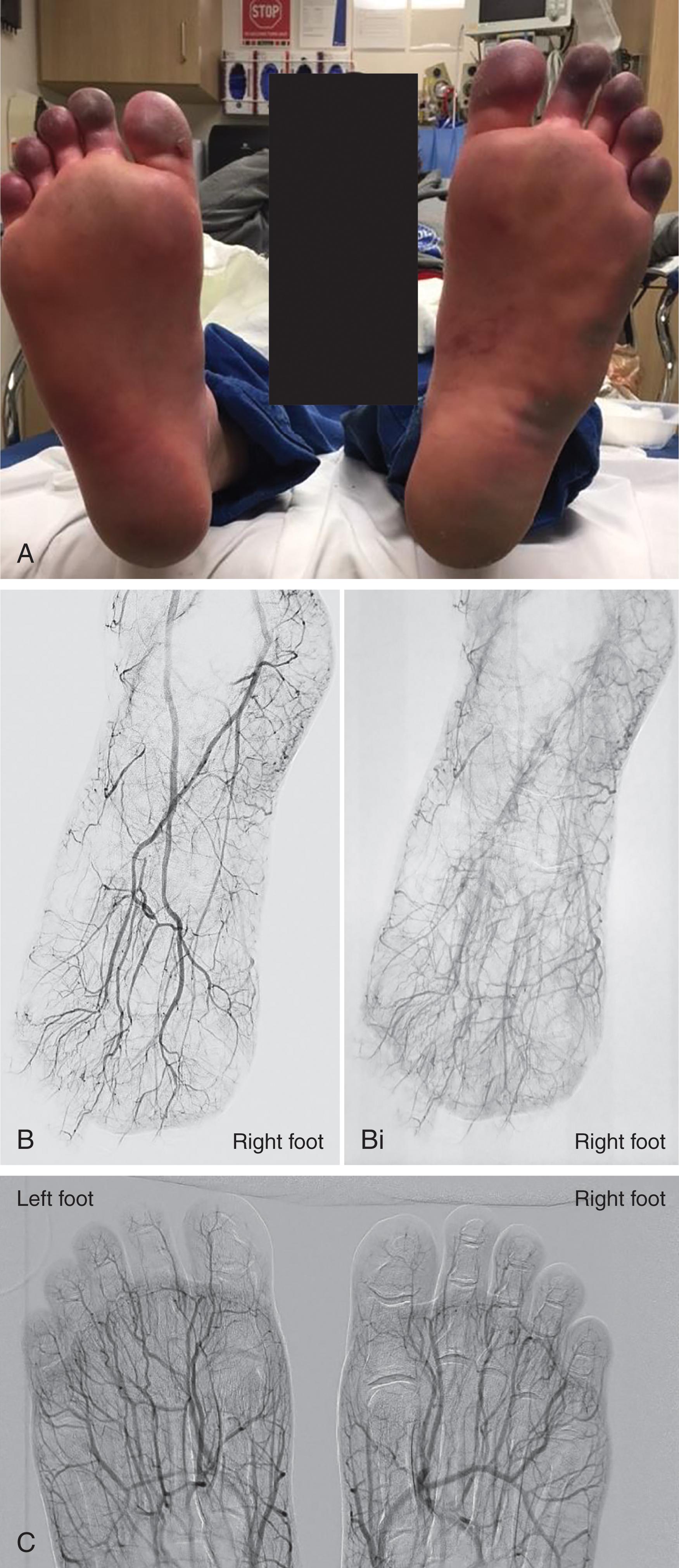 FIGURE 4, Frostbite management with intra-arterial thrombolysis. 48-year-old man found unconscious outdoors in a subzero temperature snowstorm with delayed admission to emergency department (ED). (A) Bilateral lower extremity digits dusky in color and diminished Doppler pulses and waveforms in ED. (B, Bi) Bilateral lower extremity angiogram with symmetrical decrease flow to all digits. Right foot images depicted. Arterial inflow in posterior tibial and dorsalis pedis branches is normal. (C) A 24-hour infusion of catheter-directed tissue plasminogen activator and follow-up angiogram with improved digital artery flow.