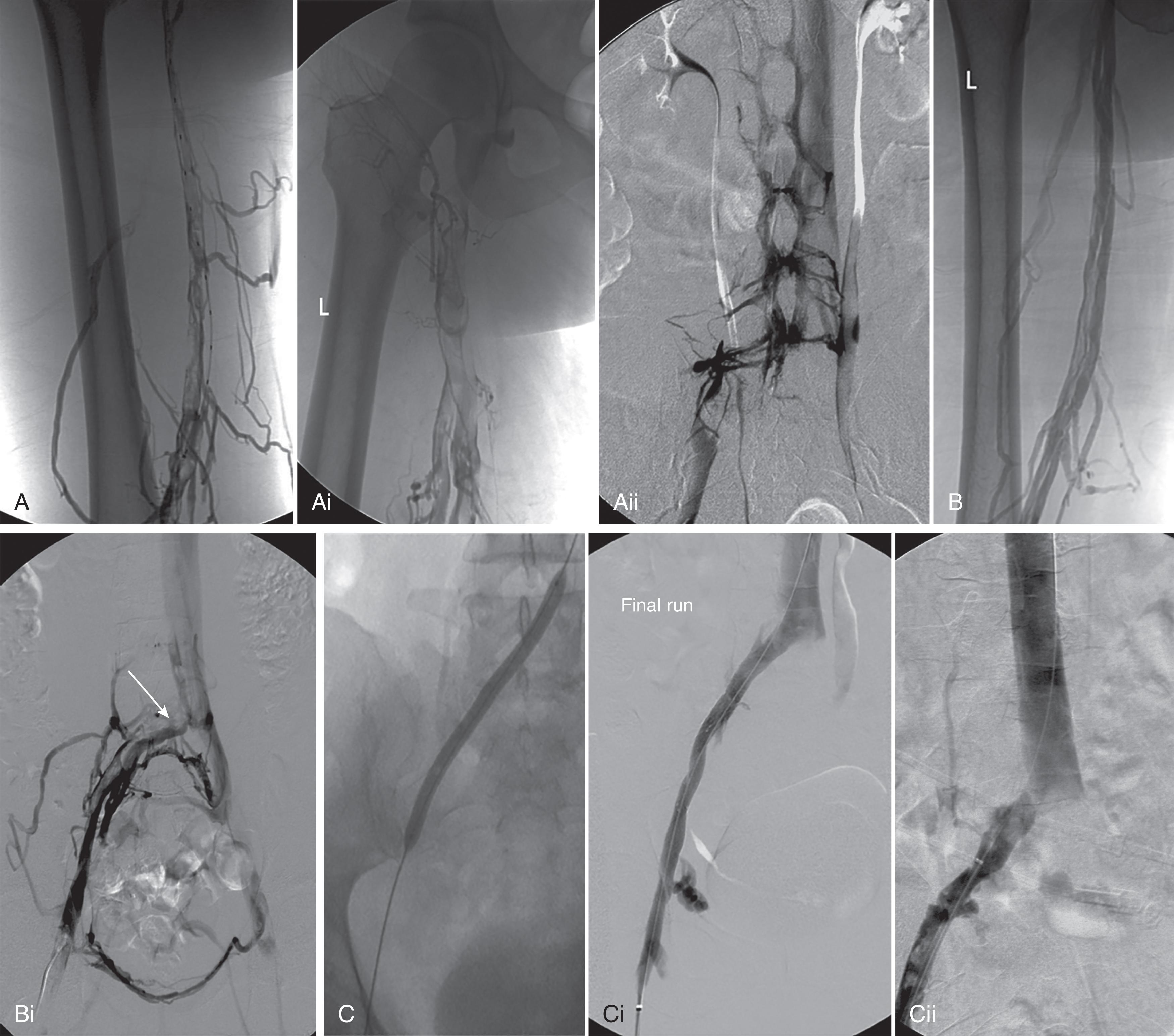 FIGURE 5, Catheter-directed deep venous thrombosis (DVT) treatment in trauma patient found to have iliac vein stenosis (May-Thurner syndrome). Young athletic woman with sports-related high-grade splenic laceration after splenectomy. One week postoperatively, during rehabilitation, she developed left lower extremity DVT with marked swelling and pain. Doppler with waveform analysis showed extensive DVT in the popliteal, femoral, and iliac system. The clinical team elected catheter-directed thrombolysis in order to reduce DVT volume due to age and mitigate the development of postthrombotic syndrome. (A–Aiii) Initial venograms of left lower extremity via left popliteal venous access showed DVT from popliteal vein to iliac vein and occluded iliac vein at the inferior vena cava junction with number paravertebral collaterals. The procedure was performed with the patient in a prone position. Tissue plasminogen activator was infused for 24 hours. (B, Bi) Follow-up venogram showed clearing of DVT in femoral-iliac system and stenosis at the common iliac vein-inferior vena cava junction, at crossover of right iliac artery and left common iliac vein, described as May-Thurner Syndrome (arrow) . (C–Cii) Balloon angioplasty was performed at the iliocaval junction with improved pelvic inflow. She was started on oral anticoagulation, and her lower extremity symptoms resolved.
