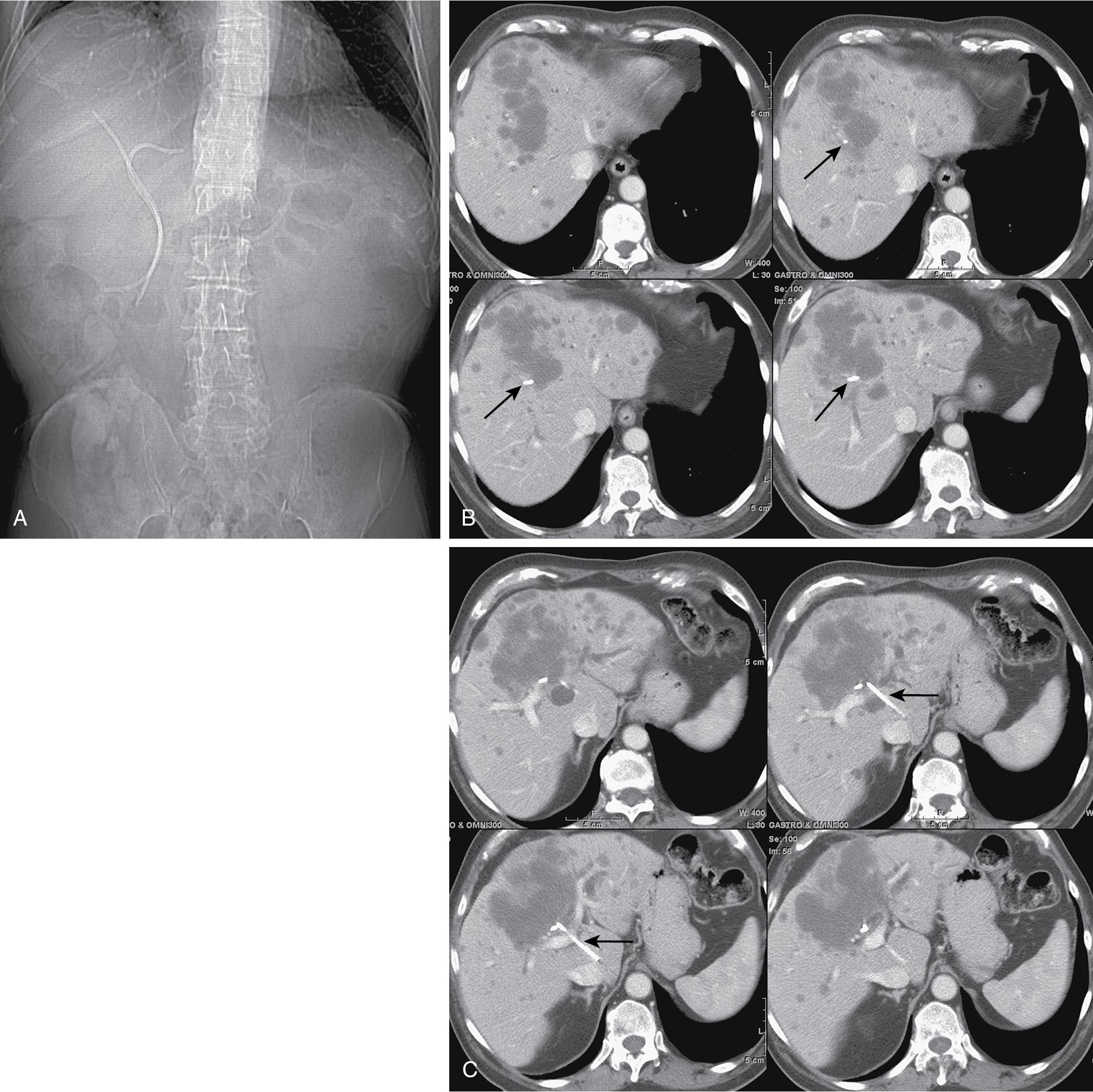 FIGURE 52.2, A, “Scout” image from abdominal computed tomography after endoscopic stent placement. The plastic stents were thought to be draining the right and left liver. The patient remained jaundiced with a bilirubin level of 10 mg/dL and white blood cell count of 18.4 K/μL. B, Plastic stent in anterior division of right hepatic duct (arrow) ; the anterior sector is almost completely replaced by tumor. Posterior bile ducts are undrained. C, The second plastic stent is in the caudate duct (arrow) ; the entire left liver is undrained.