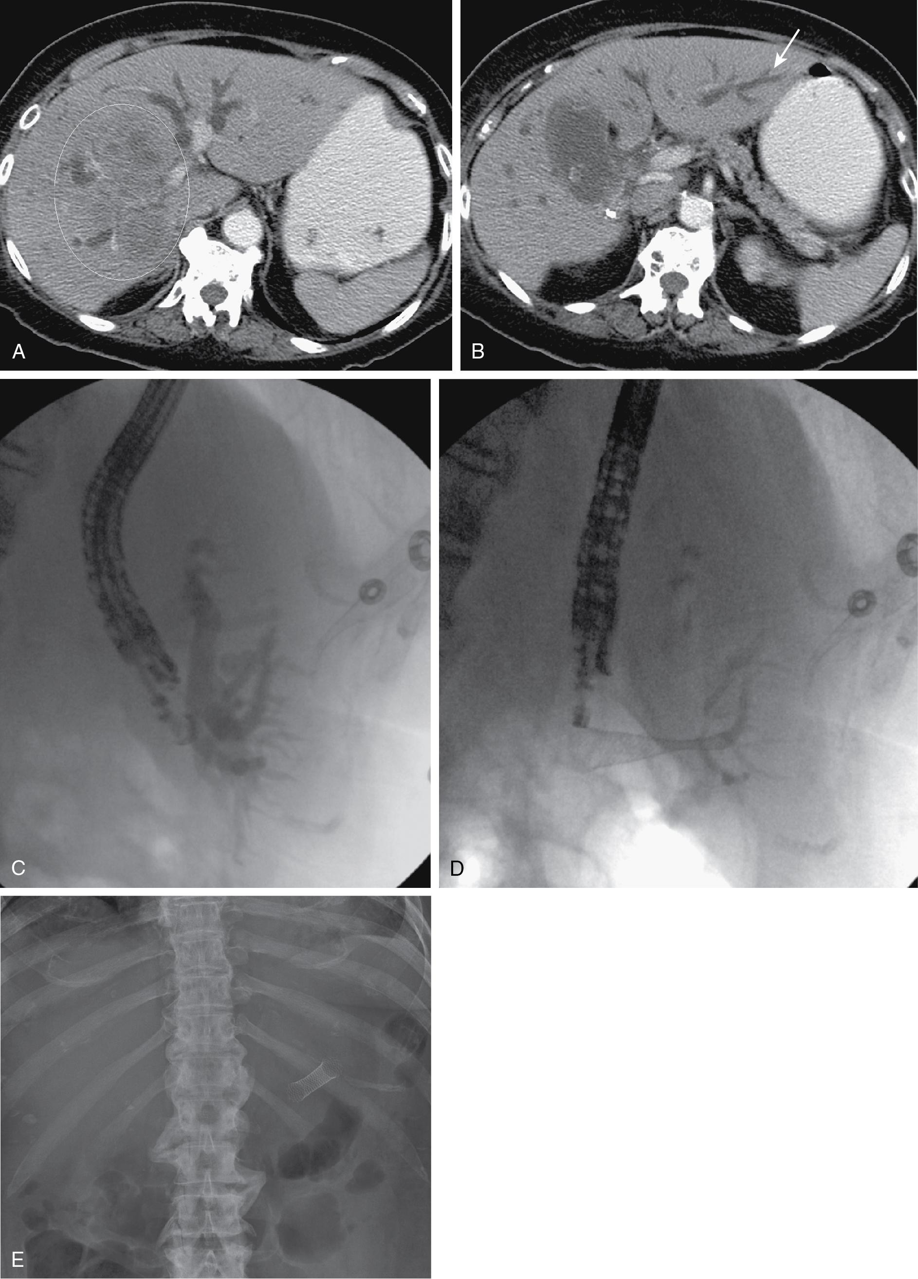 FIGURE 52.3, A, Central mass in right liver (circled) encasing the right portal vein and isolating right anterior and posterior bile ducts. B, Segment III duct (arrow) in close proximity to the stomach. C, Endoscopic image after puncture into segment III duct and injection of contrast. D, Image after placement of transgastric segment III stent. E, Image of the abdomen the next day demonstrates a well-expanded stent between the lesser curvature of the stomach and the segment III bile duct.