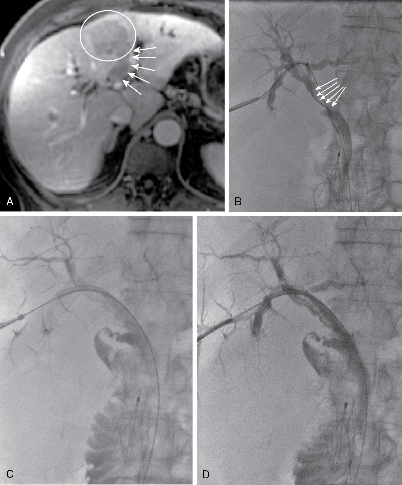 FIGURE 52.4, A, Patient with hilar cholangiocarcinoma arising in segment IV (circle) with tumor extension into left hepatic duct (arrows). B, Cholangiogram at time of drainage demonstrates tumor in left hepatic duct (LHD) compressing hilus and extending into the common hepatic duct (CHD) (arrows). C, Image at time of stent placement. Stent extends from right side to CHD, essentially excluding tumor in LHD. D, Cholangiogram after stent placement.