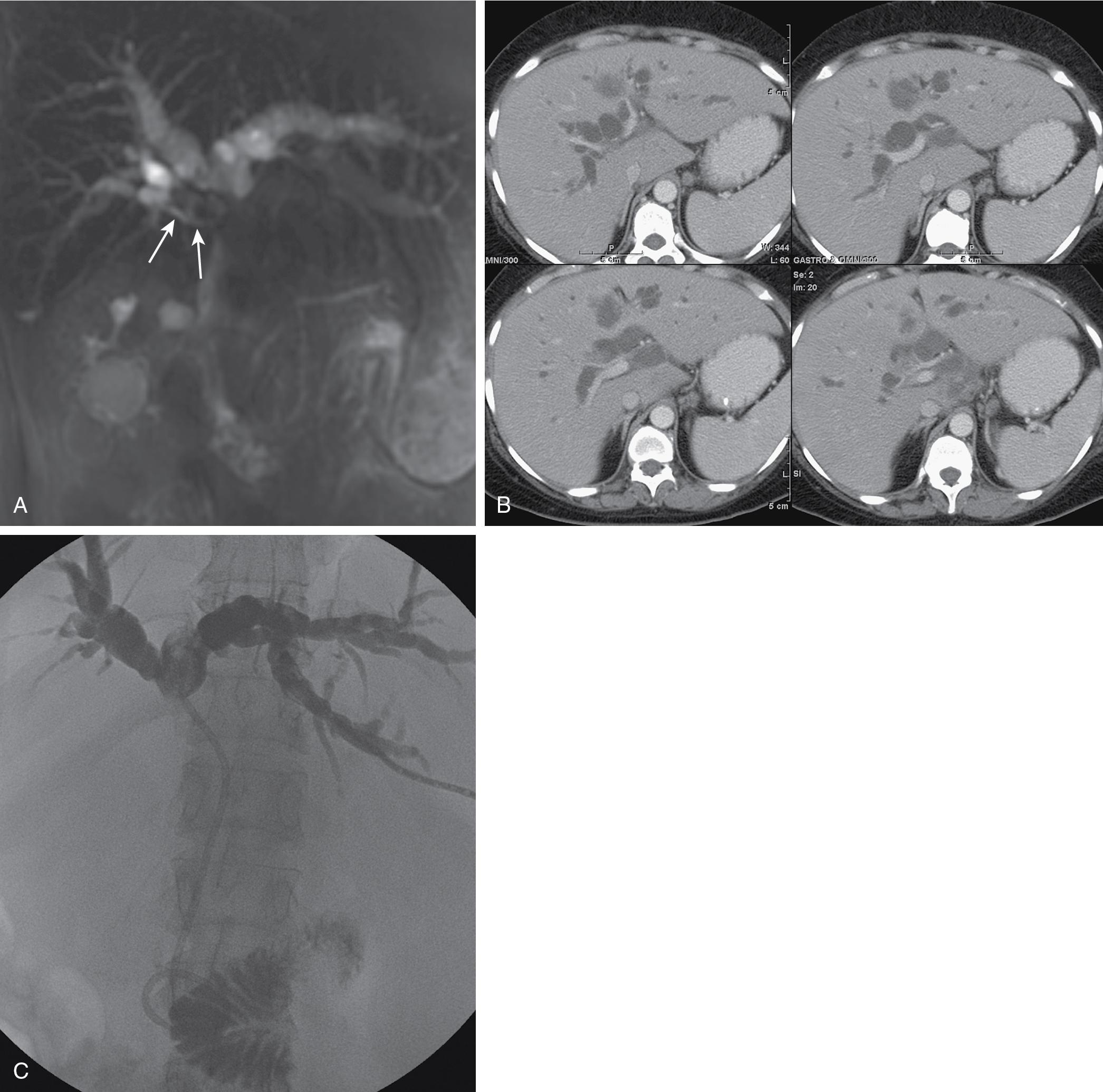 FIGURE 52.5, A, Magnetic resonance cholangiopancreatography (MRCP) in a patient with gallbladder cancer. The tumor extends into the low-inserting posterior right hepatic duct (arrows) and causes obstruction of the common hepatic duct. B, Series of contiguous axial computed tomographic images correlate well with MRCP, demonstrating right anterior and left hepatic ducts joining (top images) above the insertion of the posterior right duct, which contains material of soft tissue density (tumor) that extends into common hepatic duct (bottom images). C, Image taken at biliary drainage demonstrates the left hepatic duct joining the anterior division; a low-inserting posterior duct is isolated and thus is not opacified. The filling defect in left hepatic duct is a blood clot related to the placement of percutaneous catheter, not a tumor.