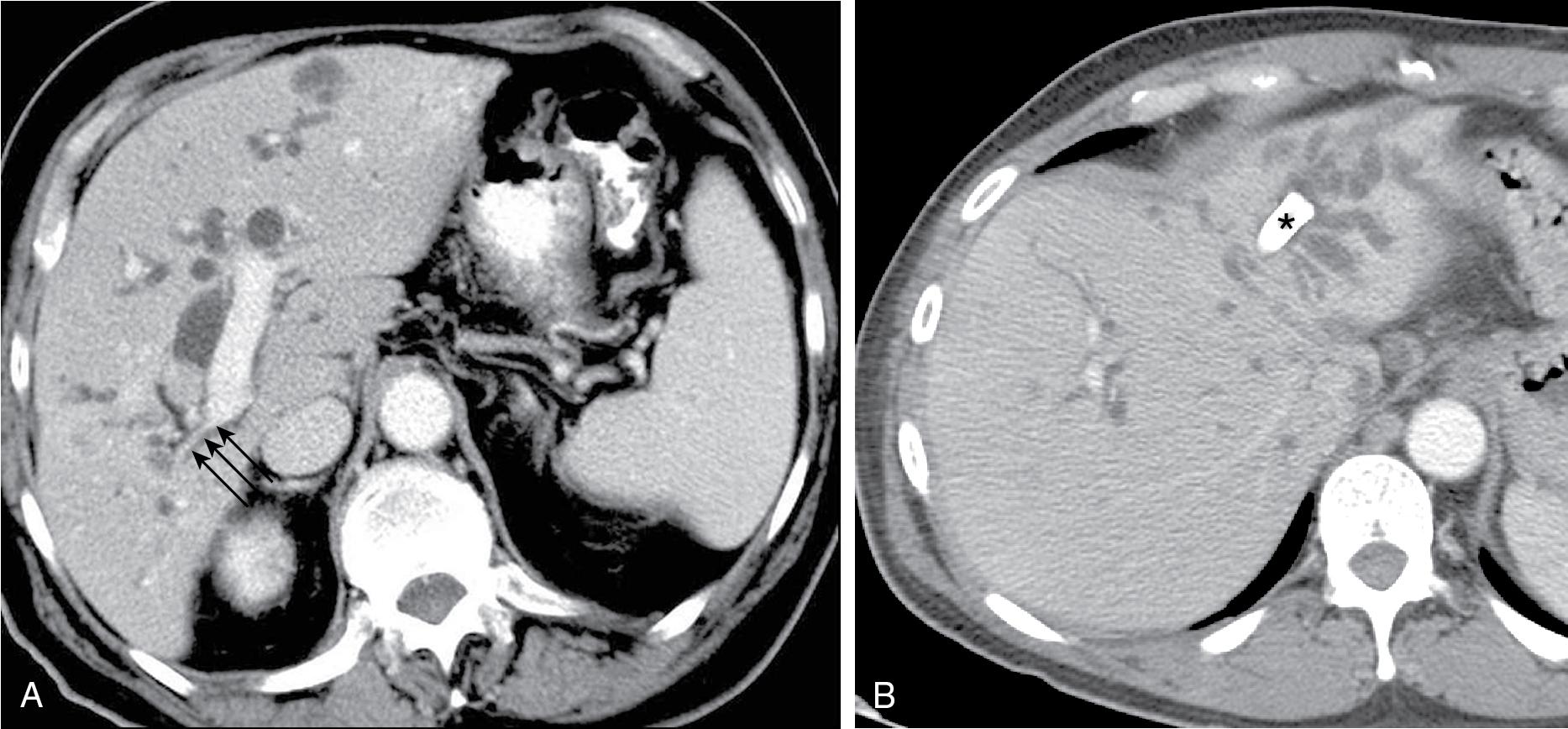 FIGURE 52.6, A, Right hepatic atrophy. Volume of the right hemiliver is greatly diminished, with severe attenuation of the right portal vein (arrows). B, Left hepatic atrophy. Note the small size of the left hemiliver and crowding of dilated bile ducts secondary to portal vein occlusion. Endoscopic stent (asterisk) had been placed at another hospital, and subsequently the patient returned with jaundice and cholangitis.