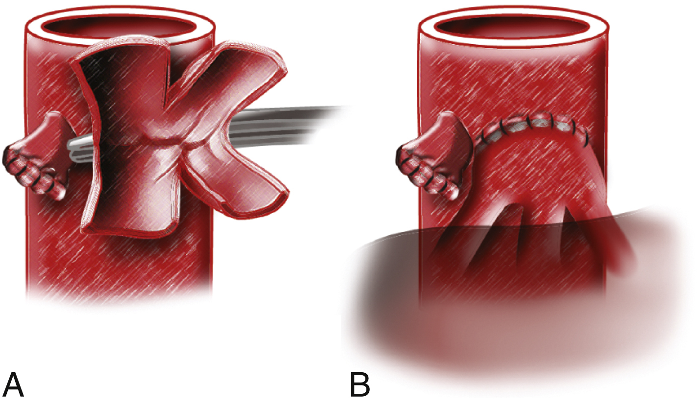 FIG. 38.1, (A) and (B) Schematic drawing of the piggyback hepatic vein reconstruction. A common cuff from the confluence of the left and middle hepatic veins of the recipient is created and anastomosed to the donor suprahepatic inferior vena cava.