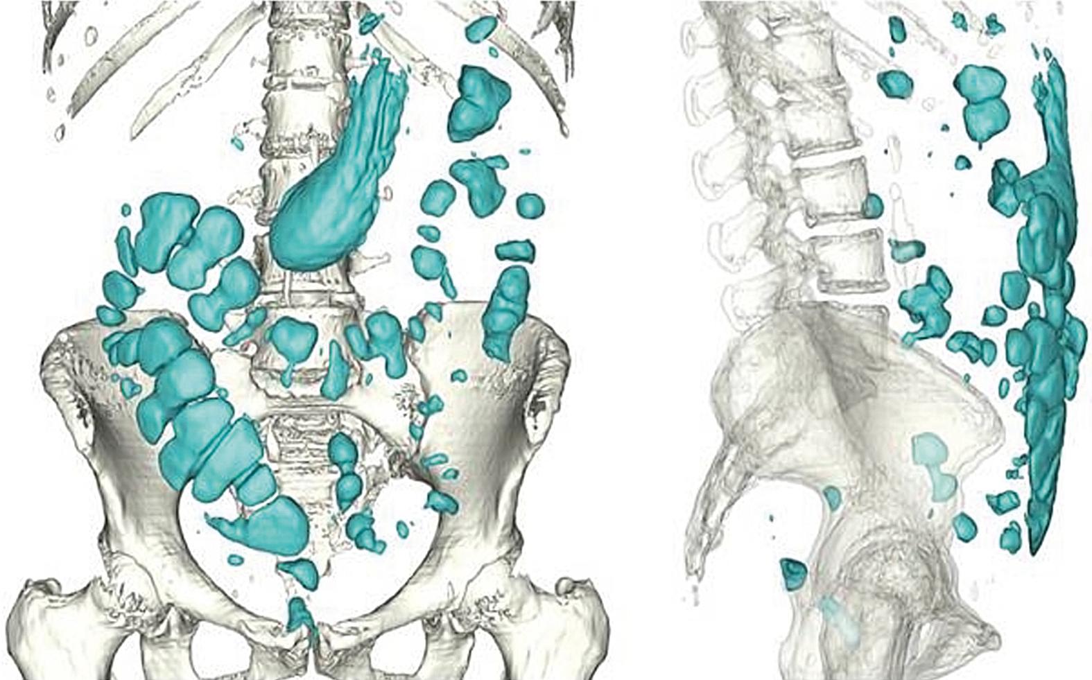 Fig. 17.1, CT image analysis of abdominal gas content ( green ) in a healthy subject in a supine position.