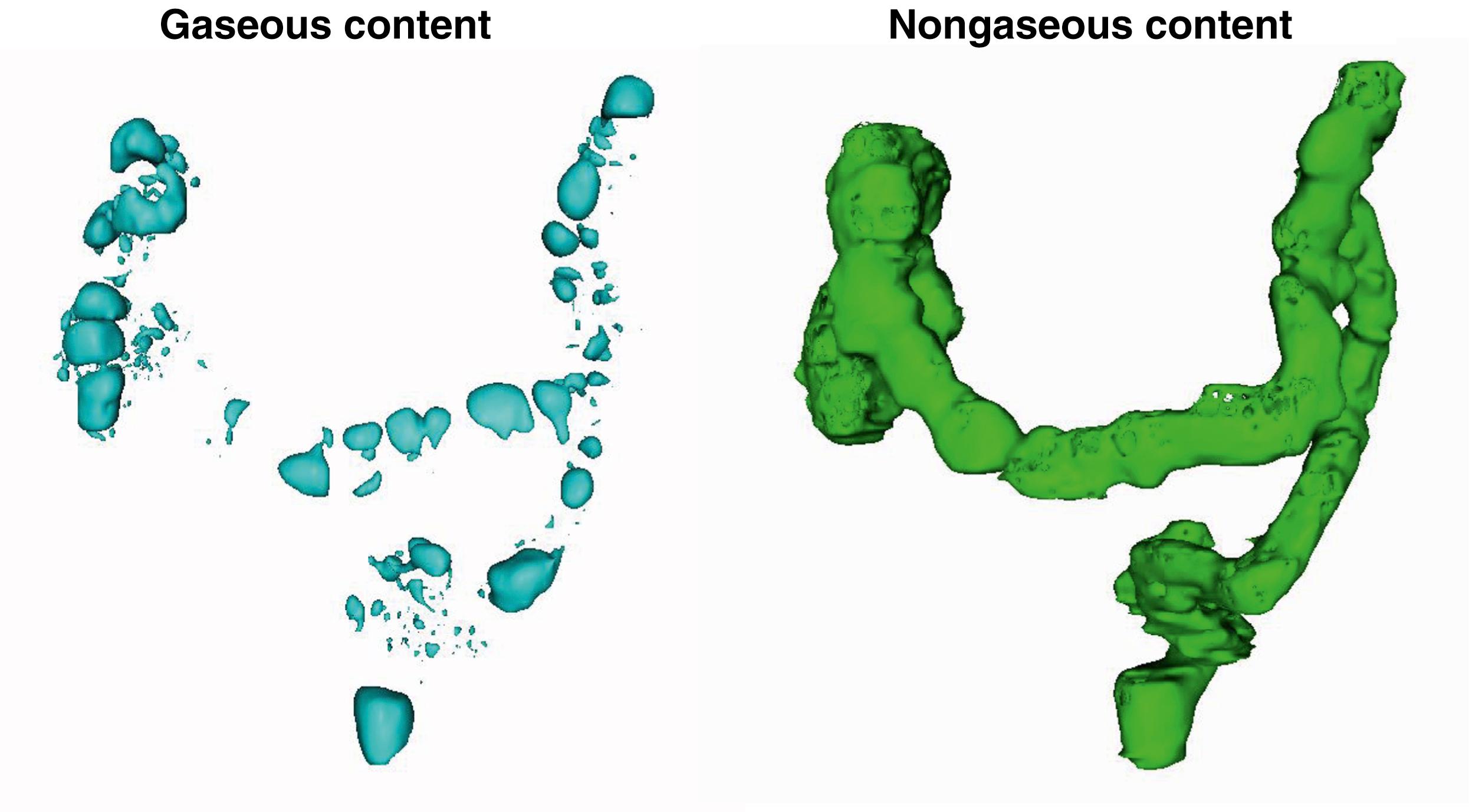 Fig. 17.4, Independent representation of gaseous and nongaseous components of colonic content on CT in a healthy subject.