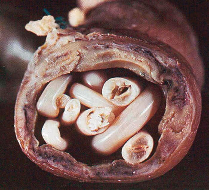 Figure 276.2, Surgical specimen showing adult Ascaris lumbricoides obstructing the small intestine.