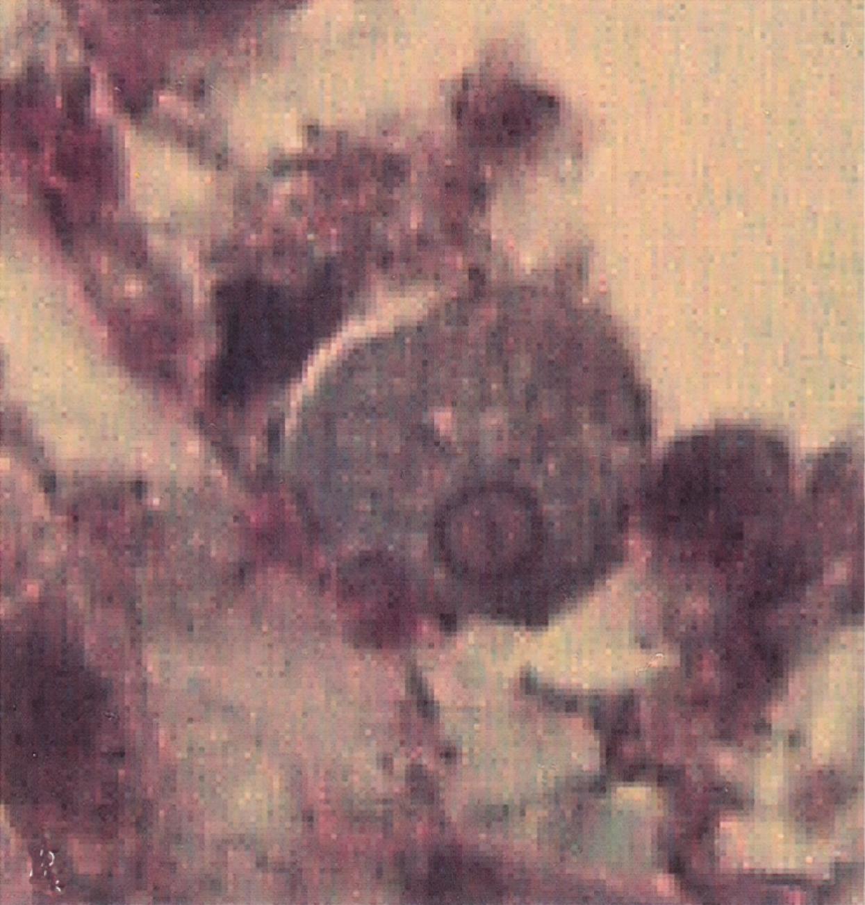 Fig. 113.1, An Entamoeba histolytica trophozoite in a stool specimen. Note the nucleus with a prominent central karyosome. (H&E stain.)