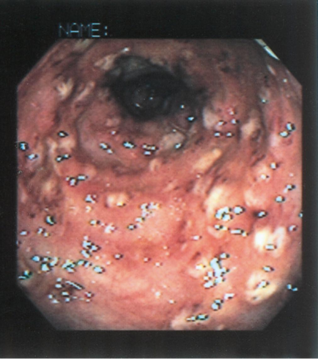 Fig. 113.3, Colonoscopic findings in a patient with amebic colitis. Multiple punctate ulcers are visible.