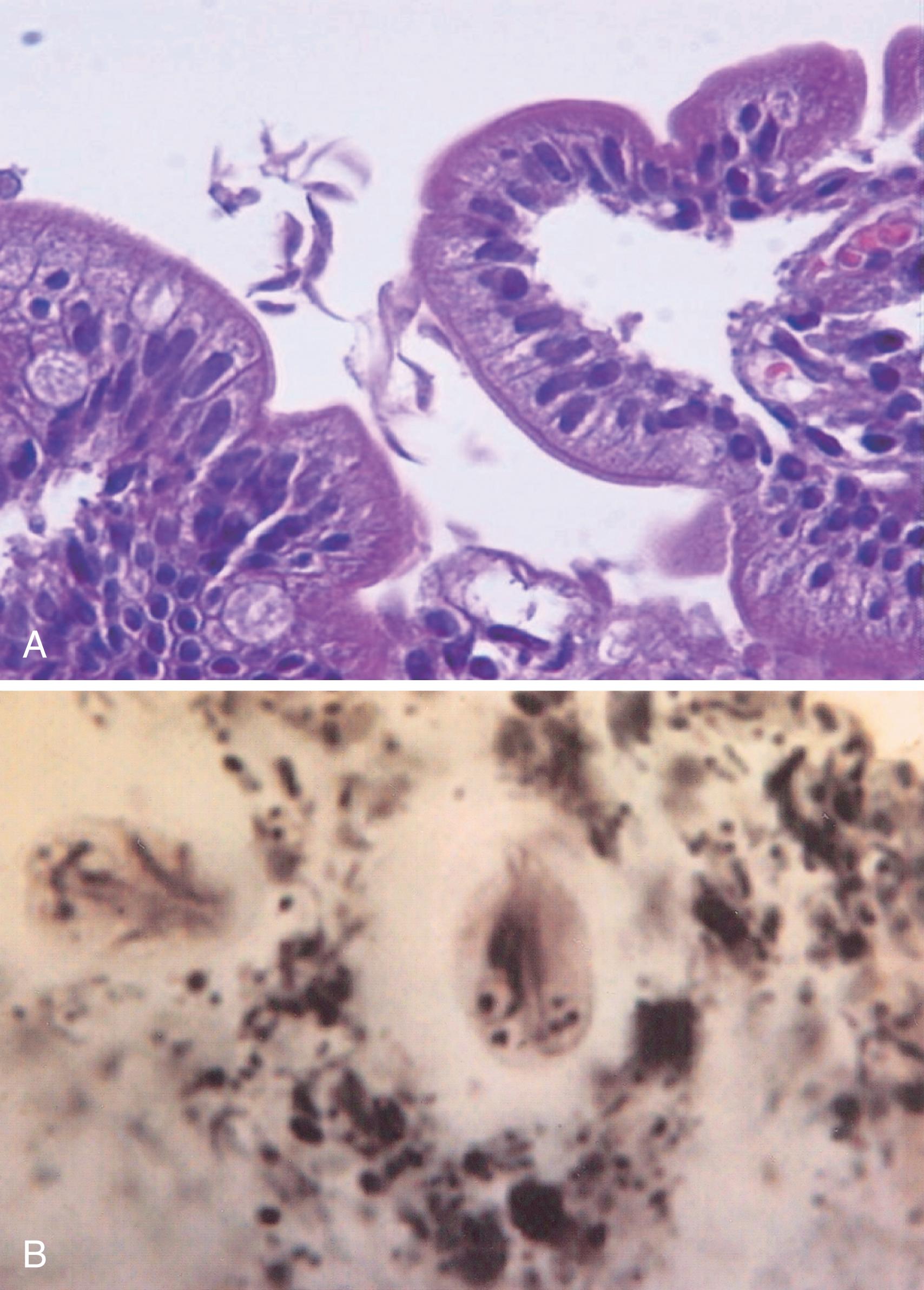 Fig. 113.5, Giardiasis. A, High-power view of a duodenal biopsy specimen showing many trophozoites near the surface of the epithelium between villi. [Giemsa stain]; B, A Giardia intestinalis cyst in stool (original magnification 400×, Giemsa stain).