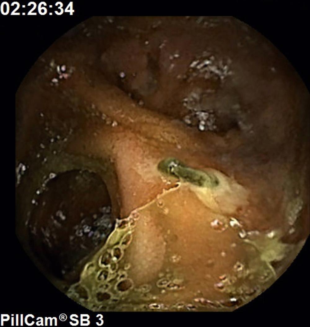 Fig. 119.1, Capsule endoscopy image of a Meckel diverticulum with ulceration and adherent clot.