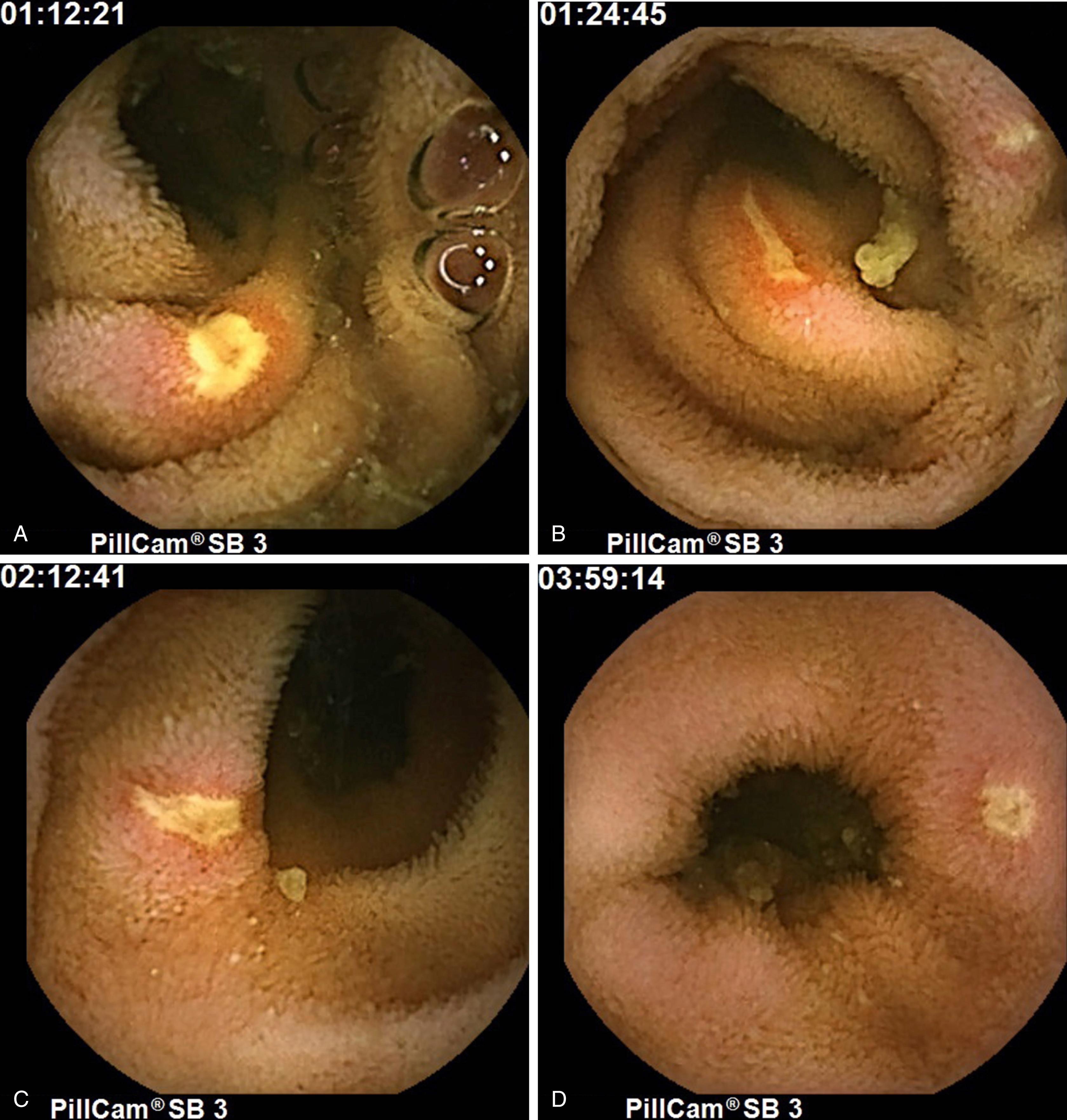 Fig. 119.2, Capsule endoscopy images of polyarteritis nodosa vasculitis with ulcerations throughout the small bowel. Images show involvement of the jejunum ( A and B ) as well as the ileum ( C and D ).