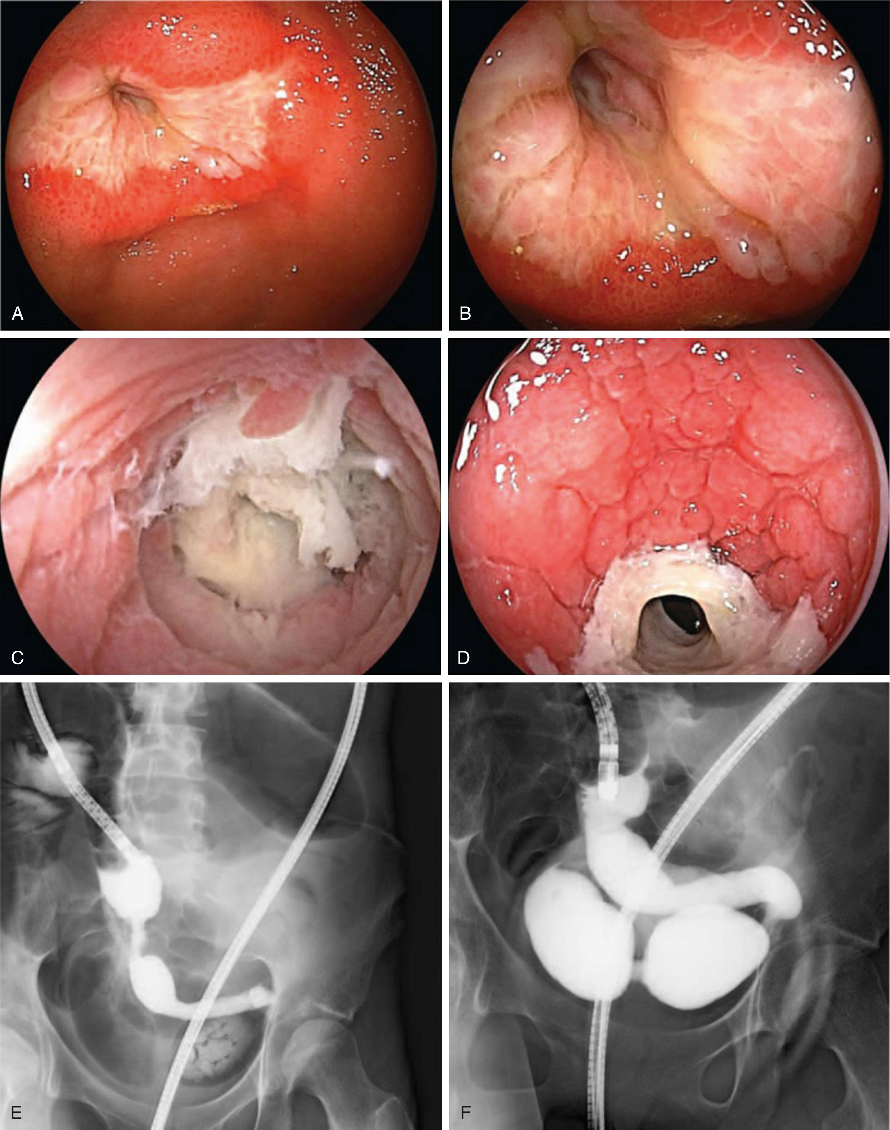 Fig. 119.3, Lupus vasculitis leading to ileal ulceration seen on double-balloon enteroscopy ( A-D ) and fluoroscopic images ( E-F ).