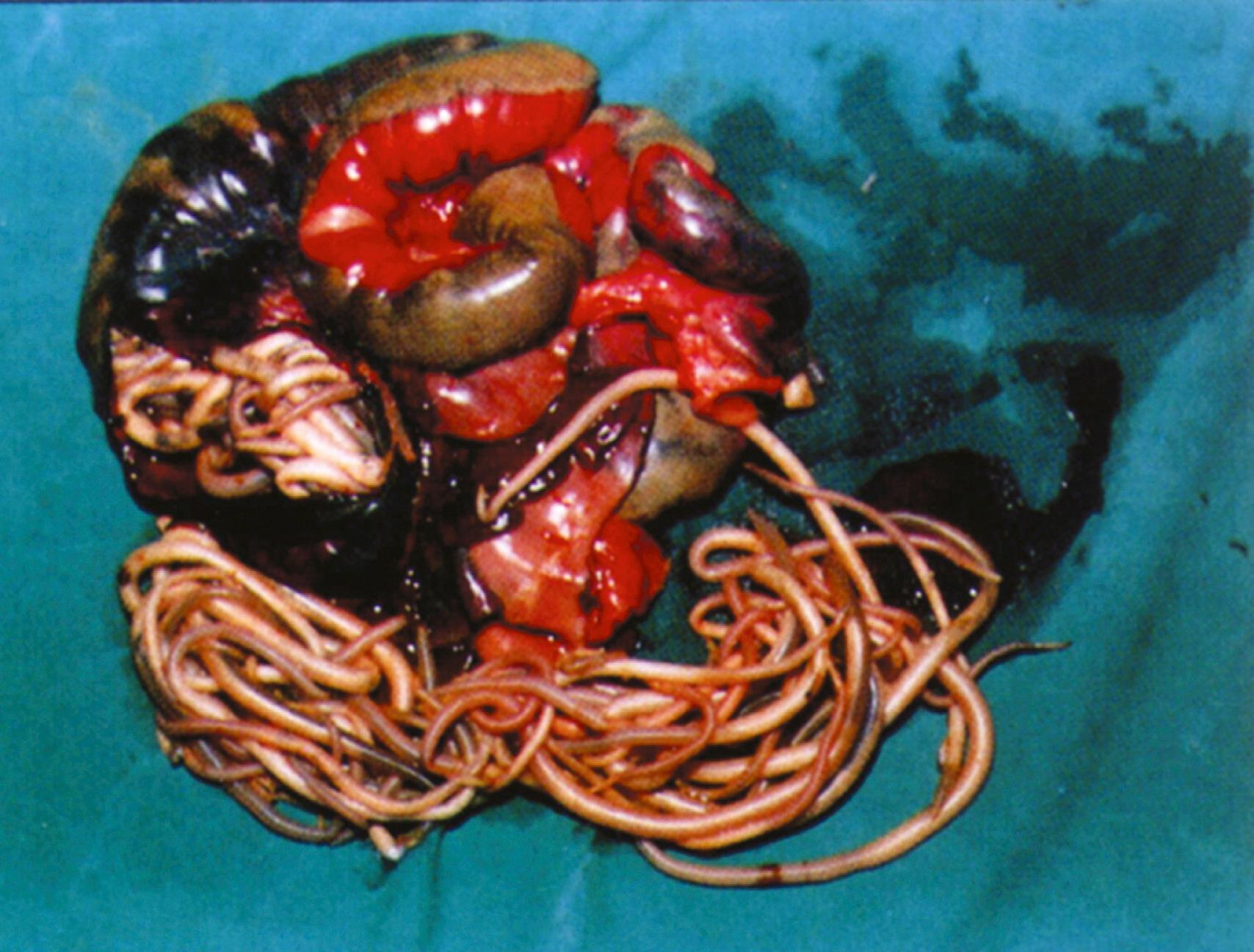 Fig. 114.1, Surgical specimen showing small bowel obstruction (with gangrene) caused by A. lumbricoides .