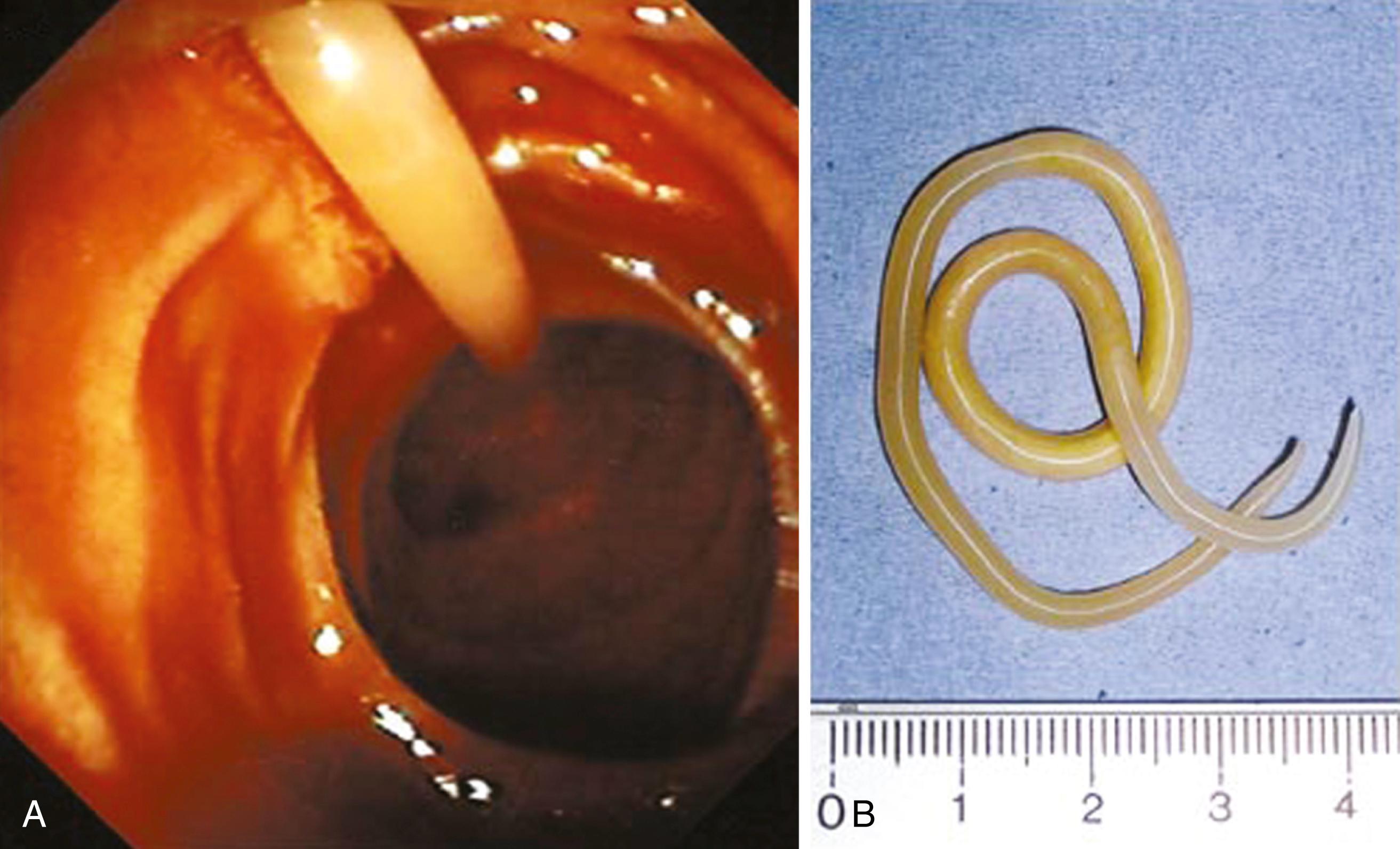 Fig. 114.2, A, Endoscopic view of A. lumbricoides partially within the ampulla of Vater. B, A. lumbricoides after removal.