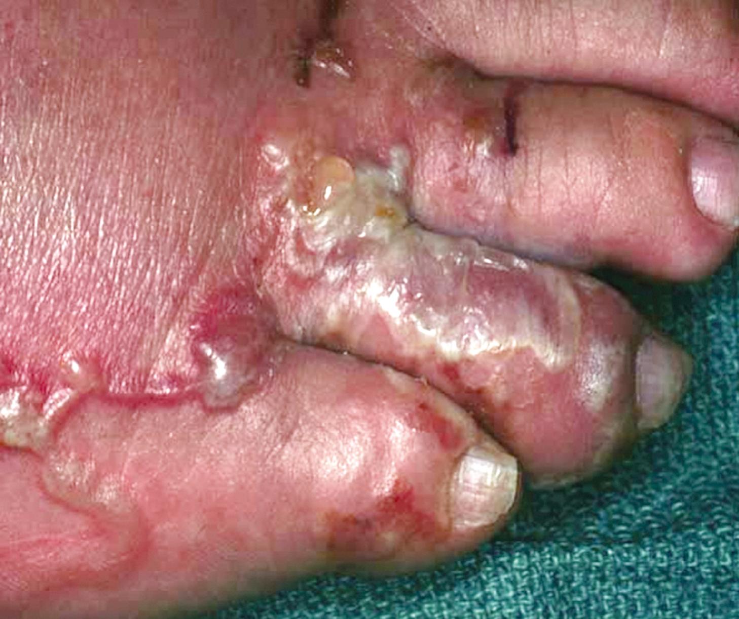 Fig. 114.5, Serpiginous rash on the foot caused by hookworm larvae migrating through the dermis.