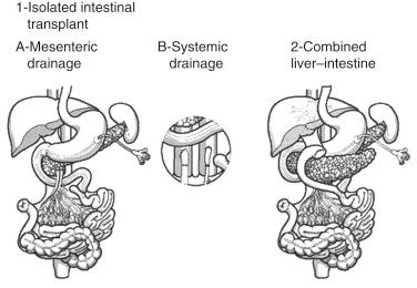 FIGURE 66-2, Types of intestinal allografts.