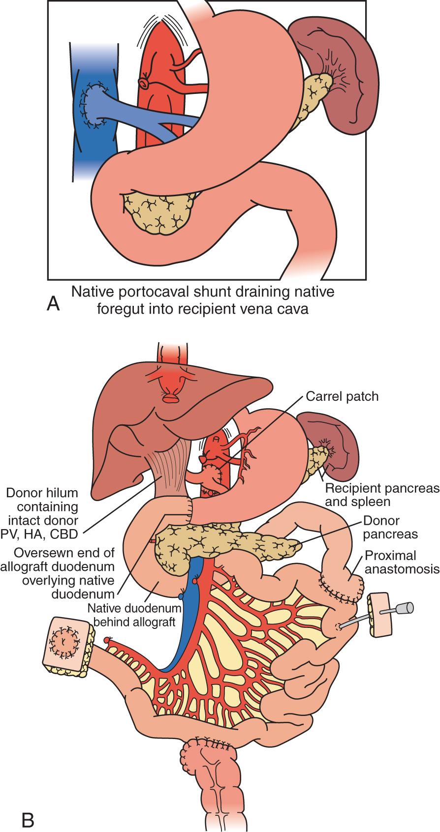 Fig. 147.5, Combined liver and intestinal transplant.