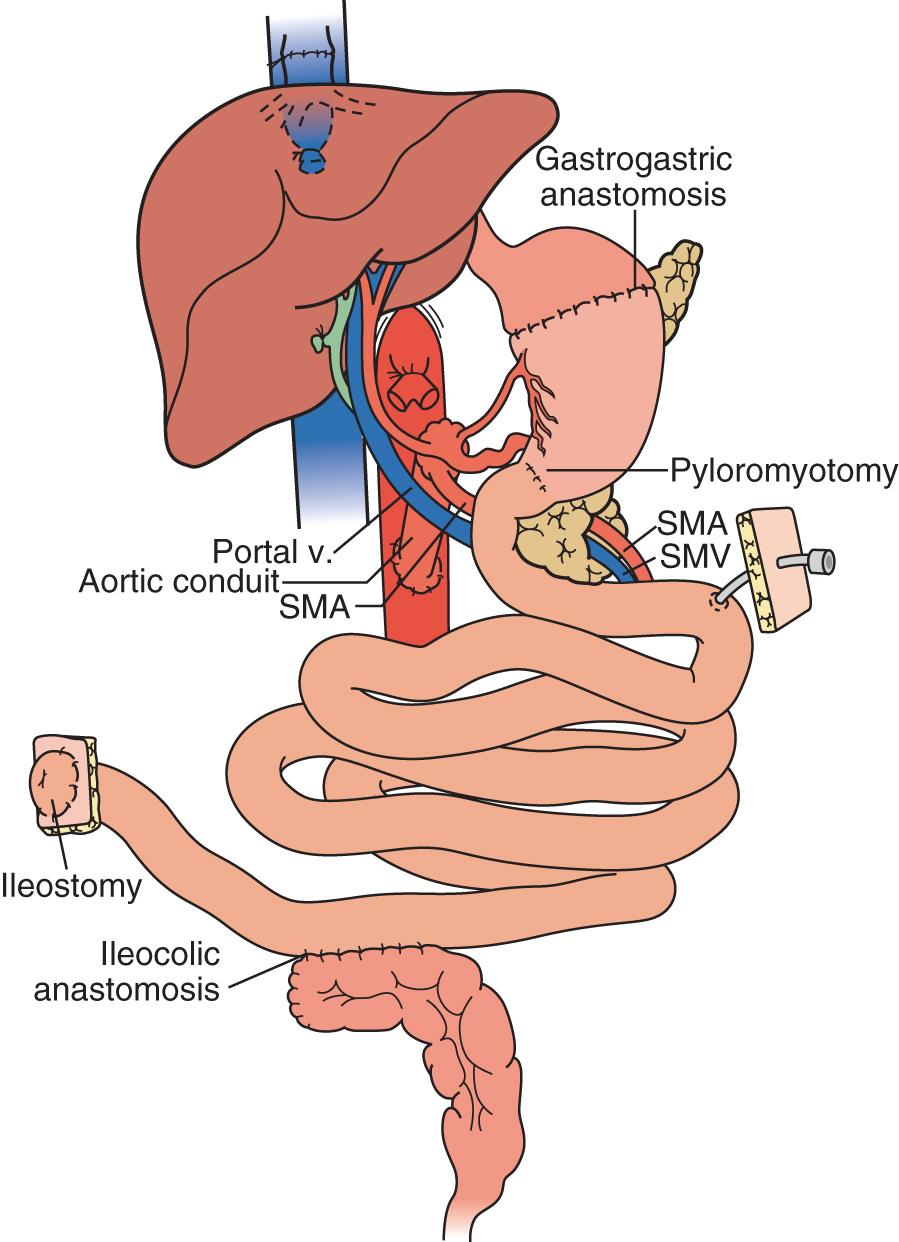 Fig. 147.6, Full multivisceral transplant.