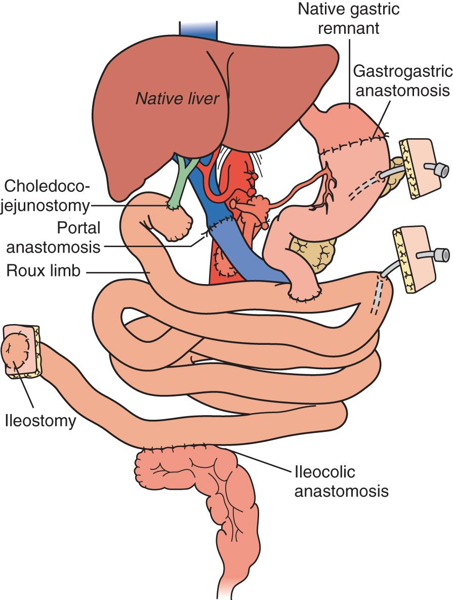 Fig. 147.7, Modified multivisceral transplant.