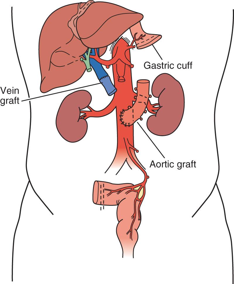 Fig. 147.8, Vascular conduit extensions for modified multivisceral transplant.