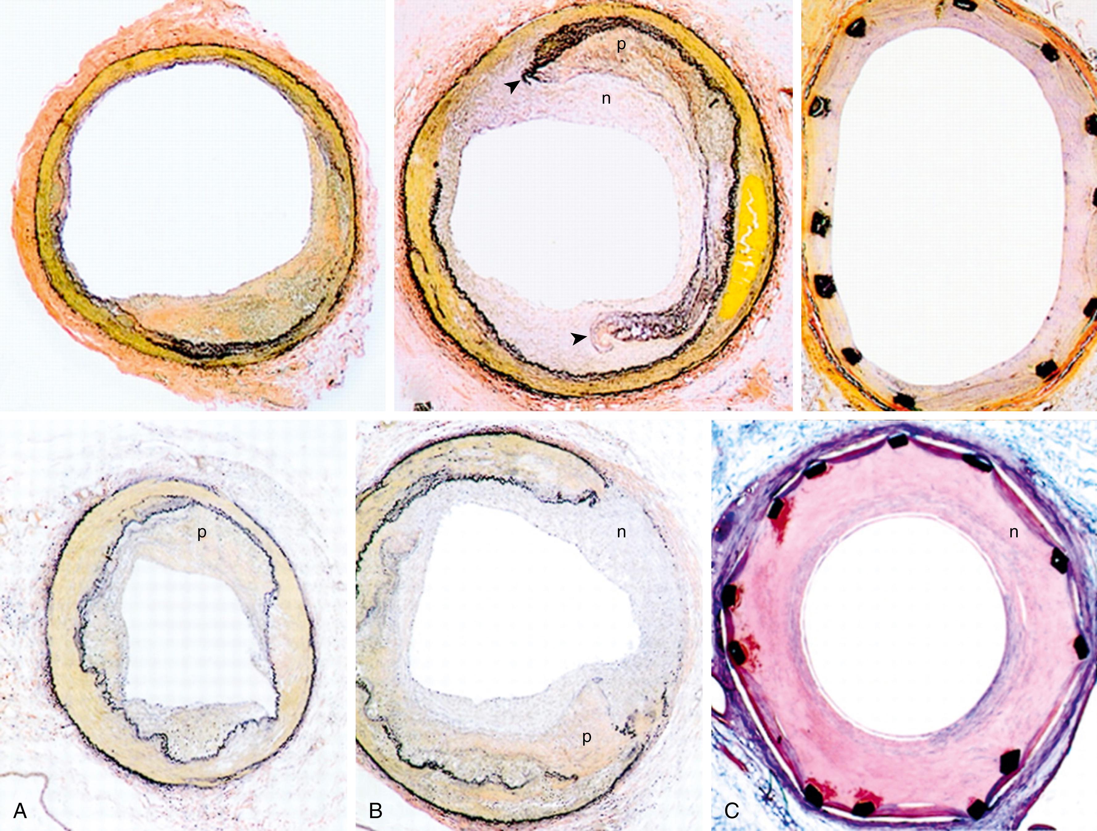 Figure 5.2, Photomicrographs of Stented Vessel.