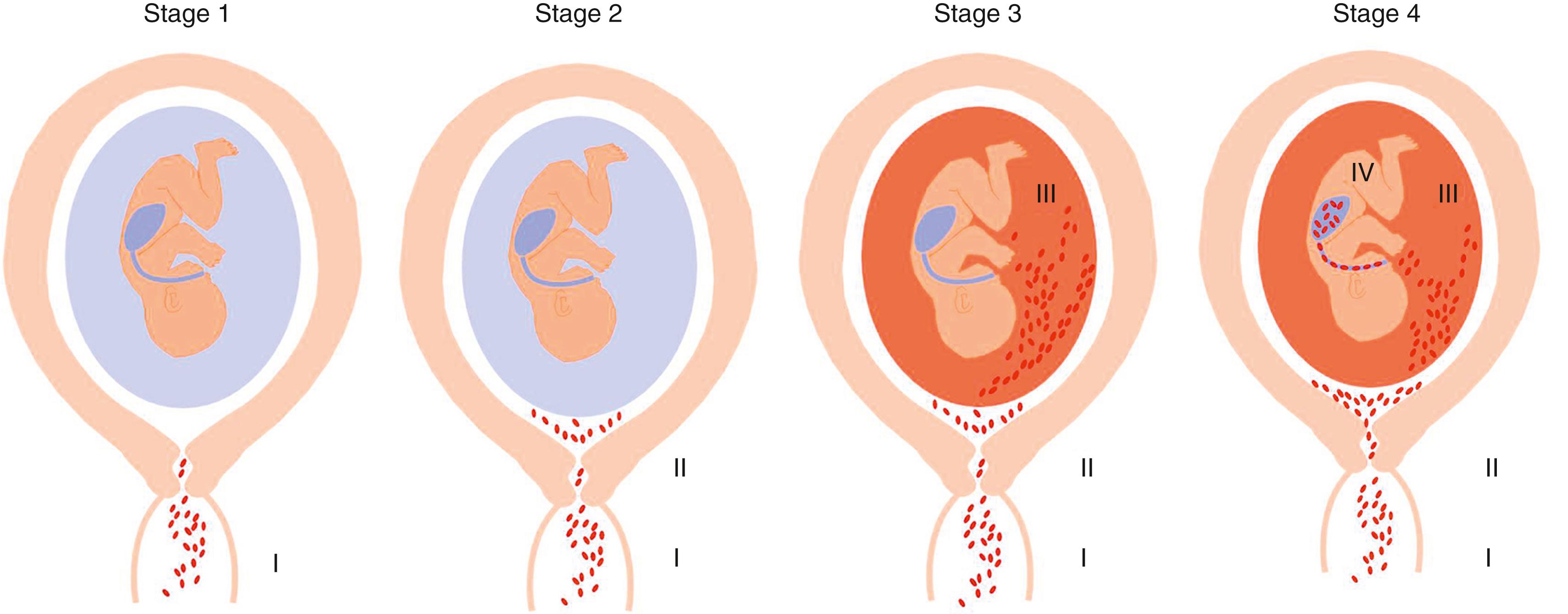 Fig. 12.2, The stages of ascending infection. The first stage corresponds to a change in the vaginal/cervical microbial flora or to the presence of pathologic organisms in the cervix. Once microorganisms gain access to the amniotic cavity, they reside in the lower pole of the uterus between the membranes and the chorion (stage 2). The microorganisms may proceed through the amnion (amnionitis) into the amniotic cavity, leading to an intra-amniotic infection (stage 3). The microorganisms may invade the fetus by different ports of entry (stage 4).