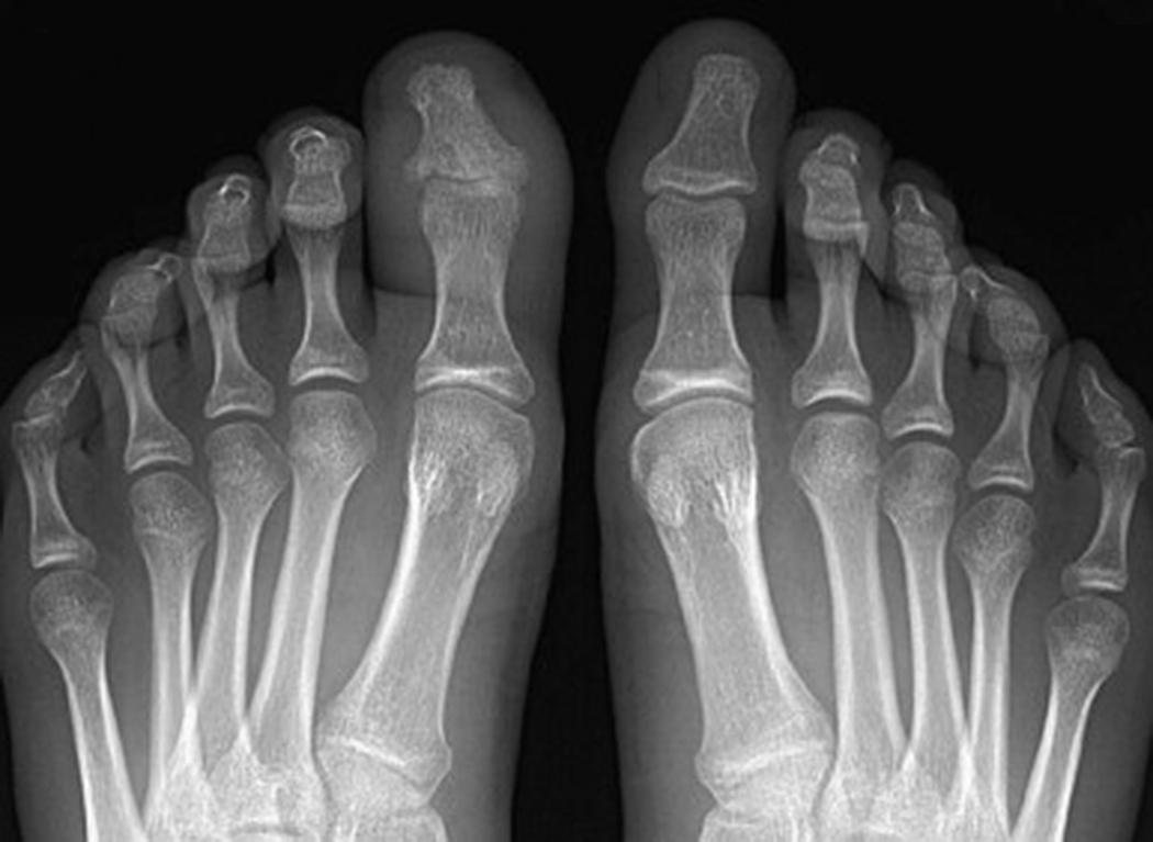 FIG. 178.1, Dactylitis of the left great toe in a child with psoriatic arthritis. There is diffuse soft-tissue swelling of the digit along with narrowing of the first metatarsophalangeal and interphalangeal joints. Irregularity of the base of the distal phalanx is present.