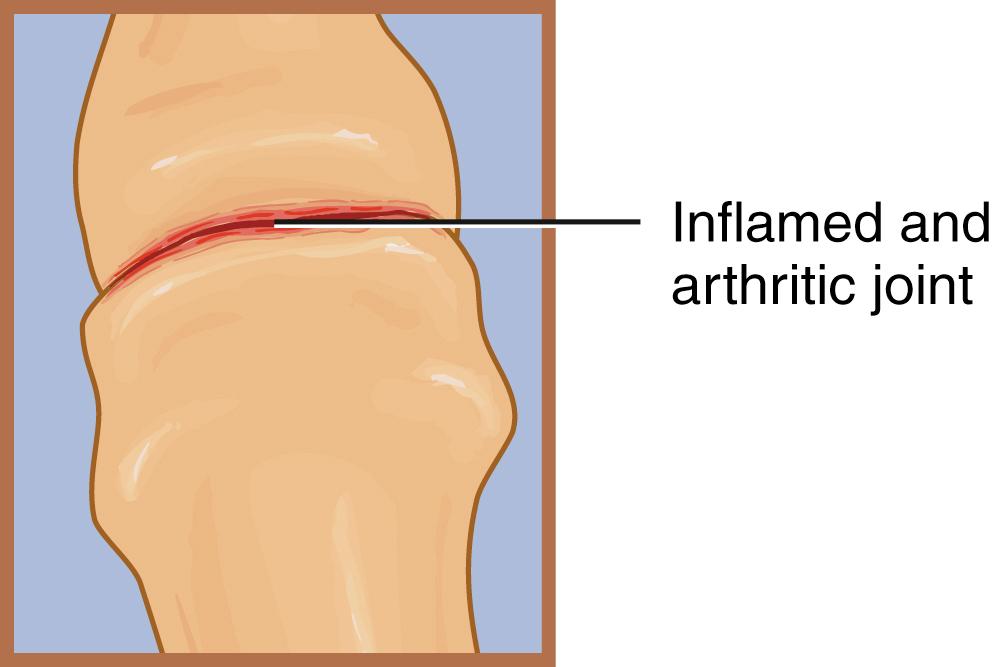 FIG. 178.2, The pain associated with arthritis of the toe joints is amenable to treatment with intra-articular injection of the toe joints.