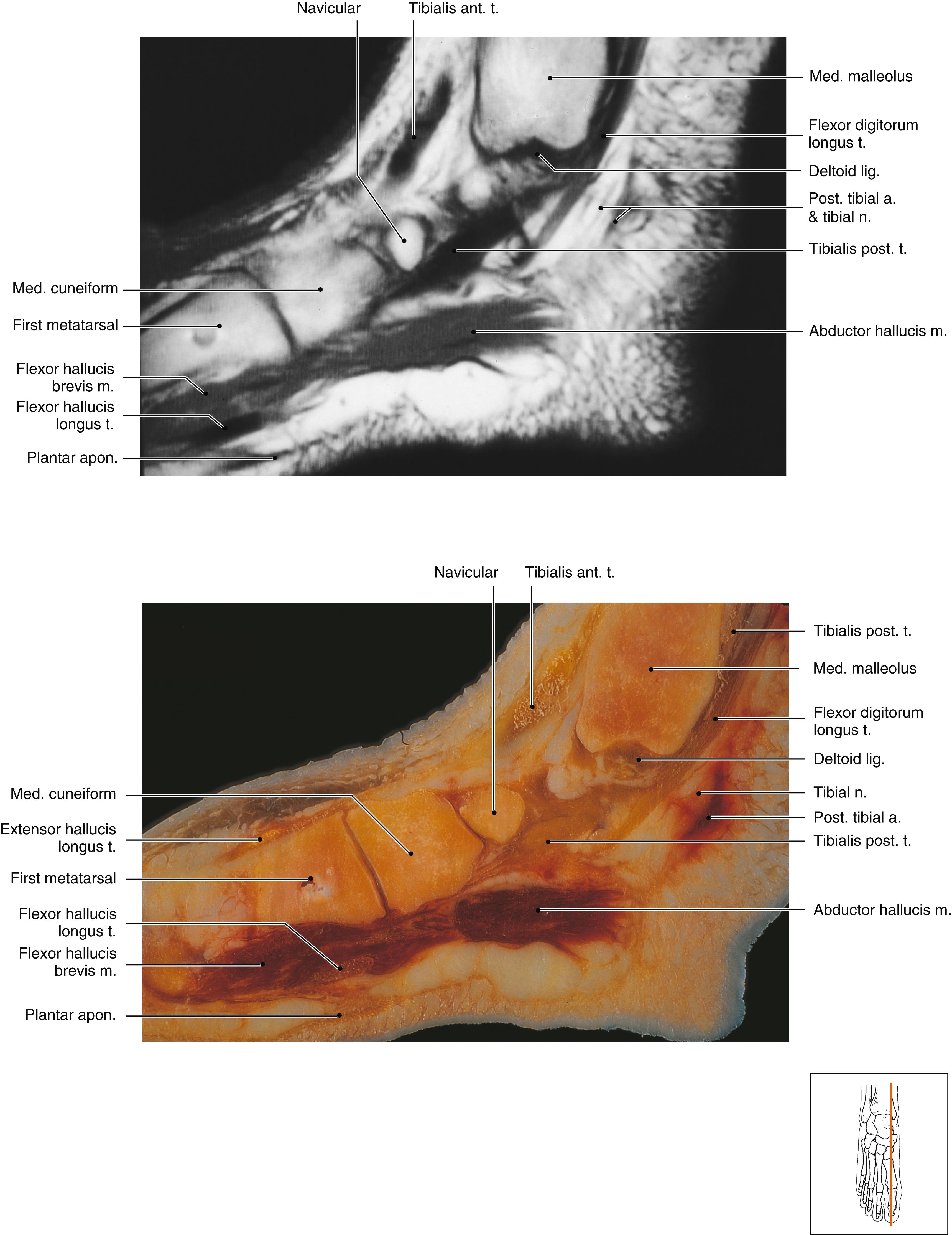 FIG. 178.3, Ankle and foot, sagittal. a, Artery; ant, anterior; apon., aponeurosis; lig, ligament; m, muscle, med, medial; n, nerve; post., posterior; t, tendon.