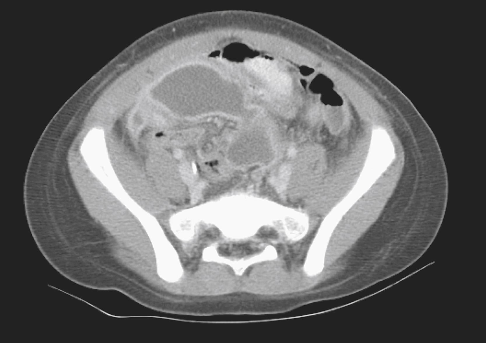 FIGURE 66.1, A postoperative intra-abdominal abscess is visualized by computed tomography. This rim-enhancing fluid collection has the typical appearance of an abscess.