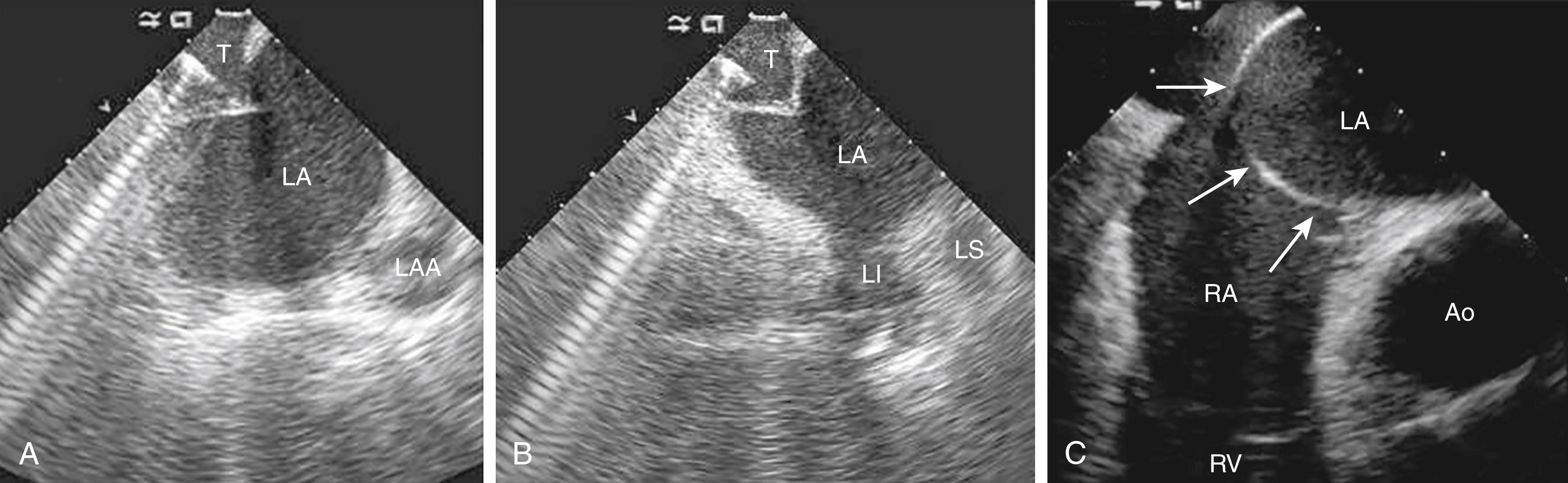 Fig. 66.1, By using intracardiac echocardiography, the location of the transseptal needle crossing can be optimized.